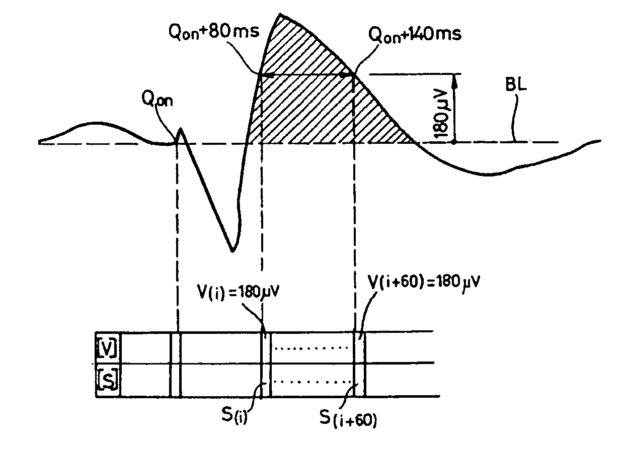 Electrocardiologic device for the assisted diagnosis of brugada syndrome or early repolarization syndrome