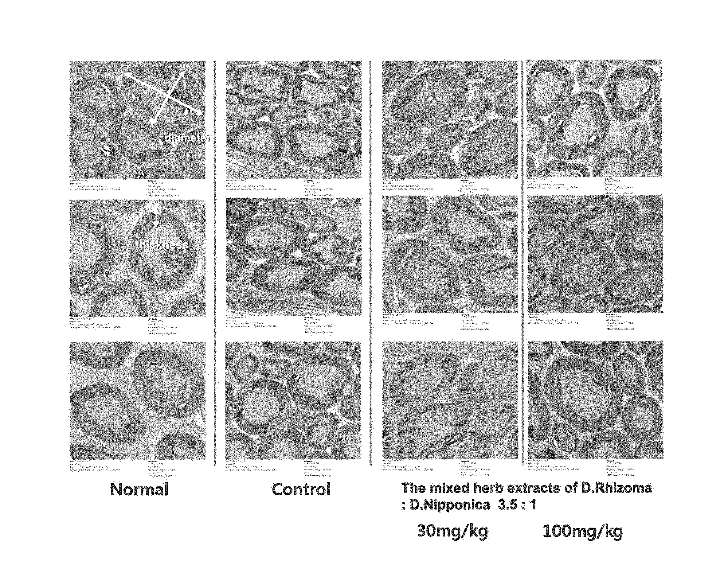 Composition comprising the extract of herbal combination for preventing or treating diabetic peripheral neuropathy