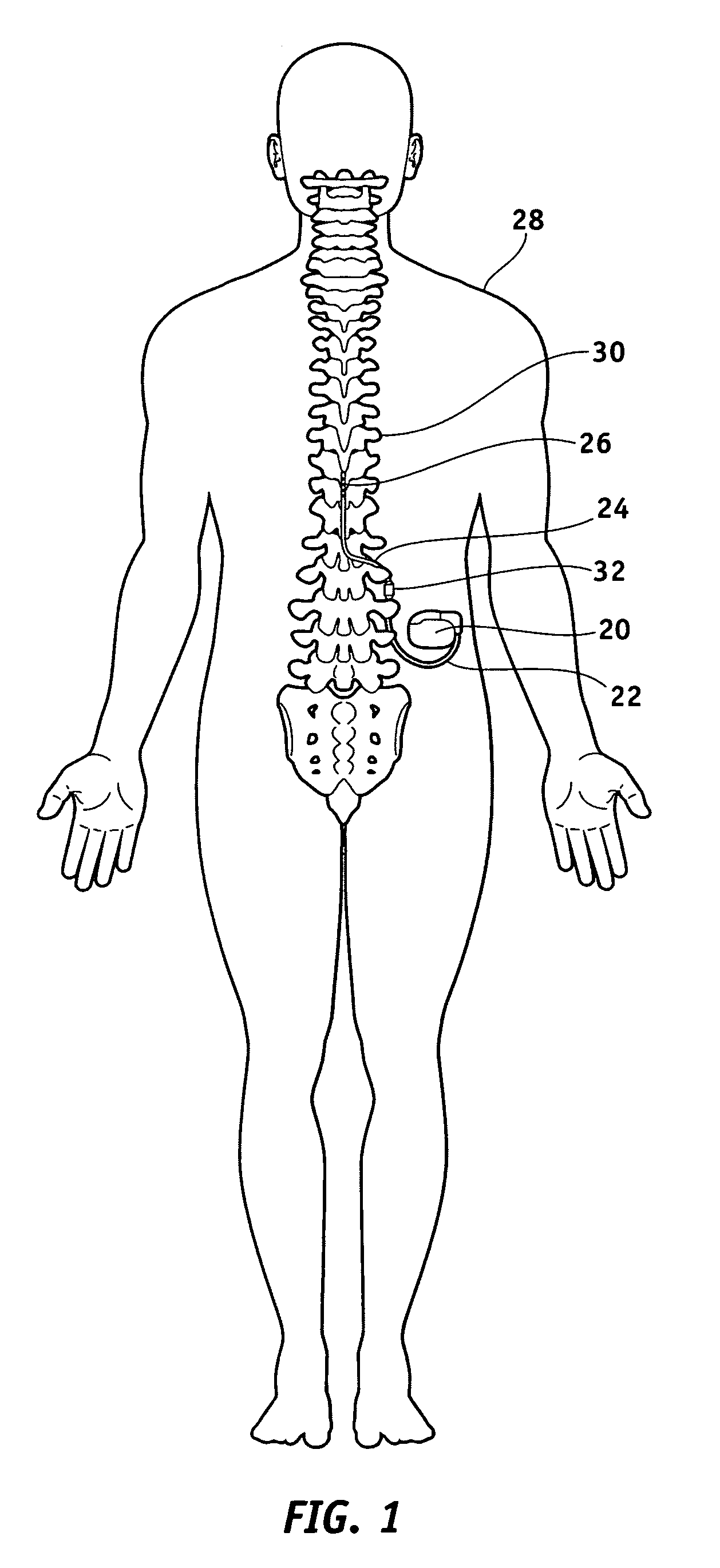 Lead electrode for use in an MRI-safe implantable medical device