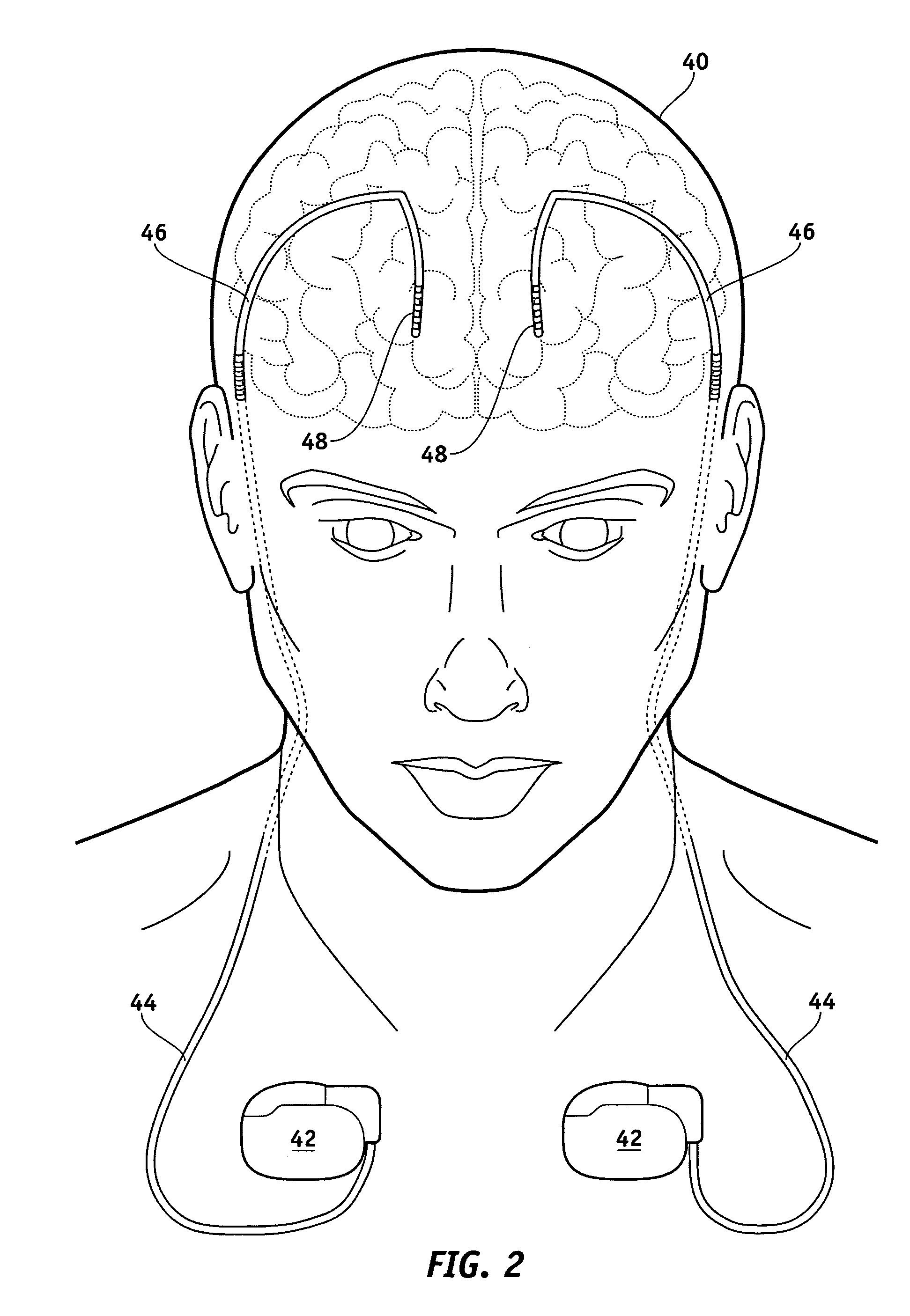 Lead electrode for use in an MRI-safe implantable medical device