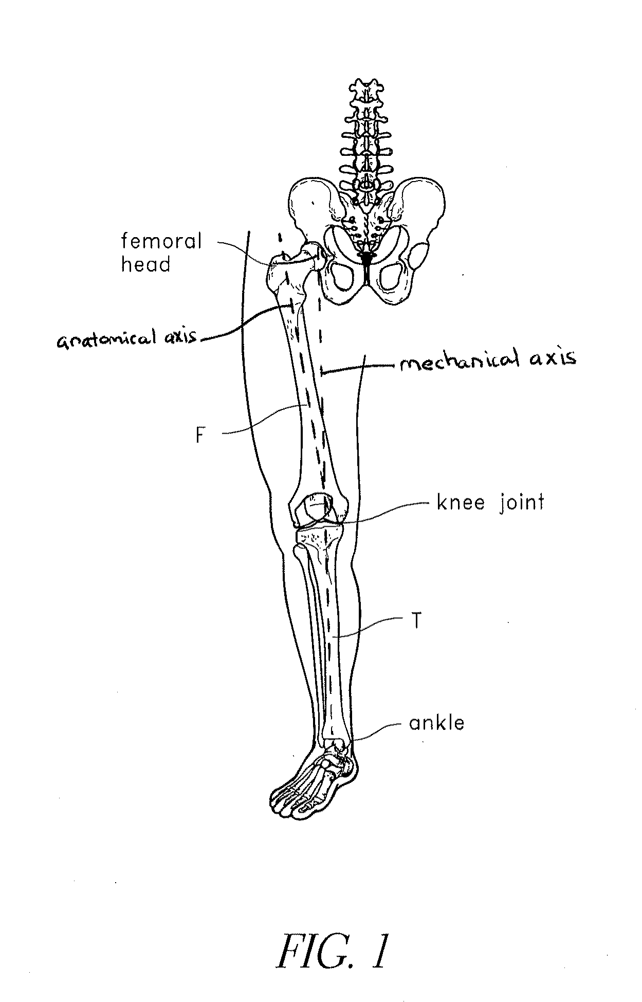 Systems and methods for joint replacement