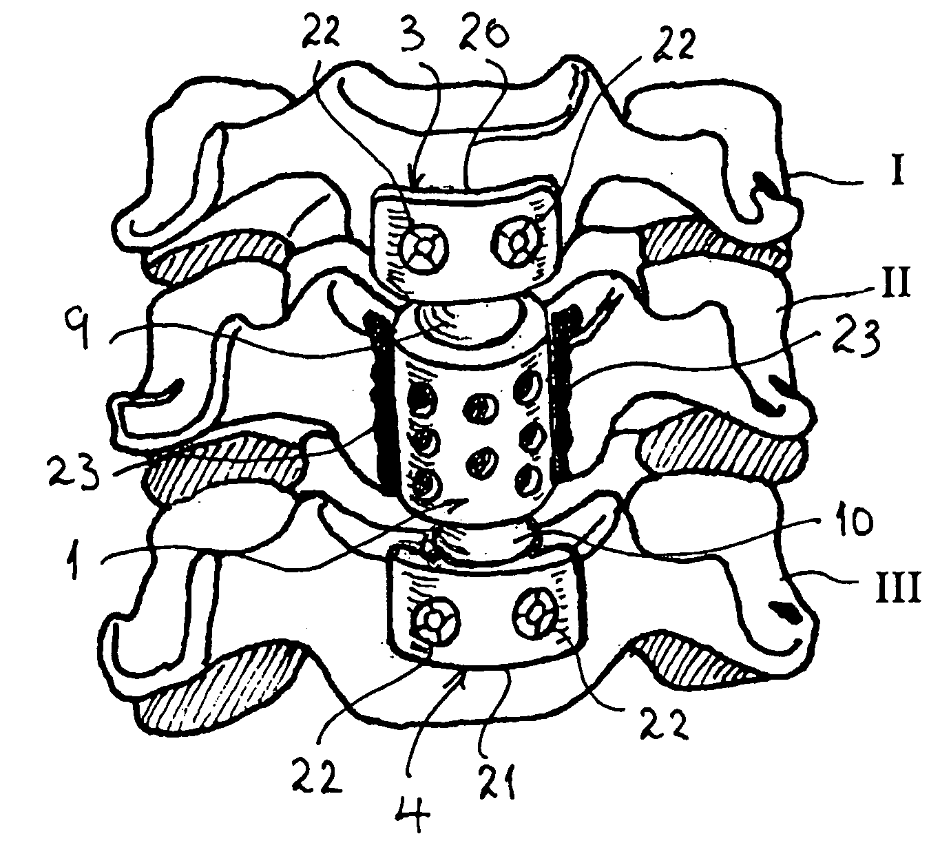 Spinal prostheses