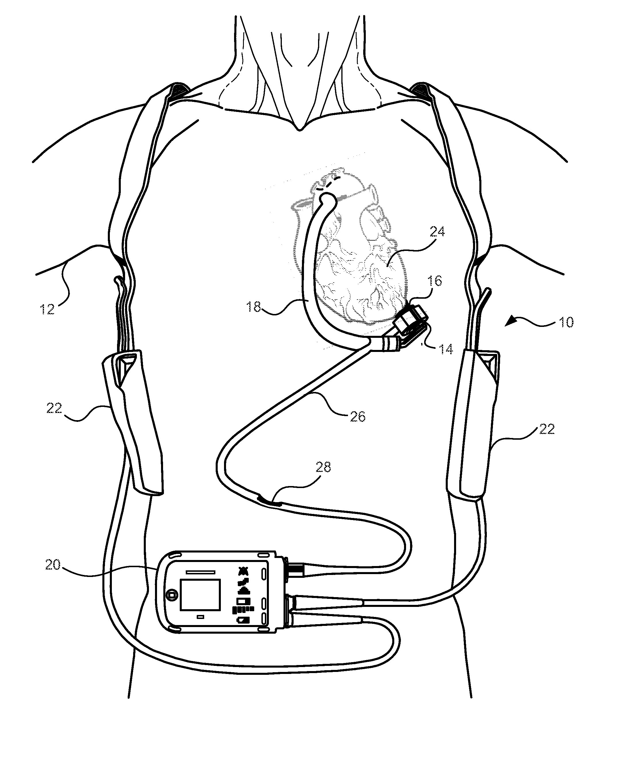 Methods and Systems for Controlling a Blood Pump