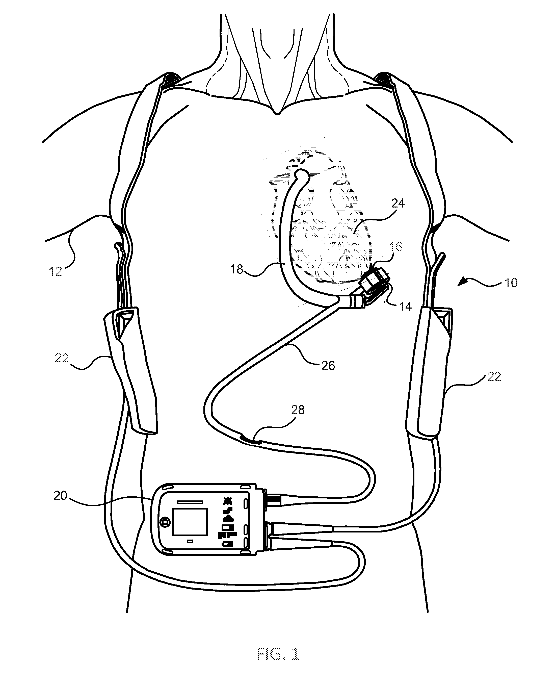 Methods and Systems for Controlling a Blood Pump