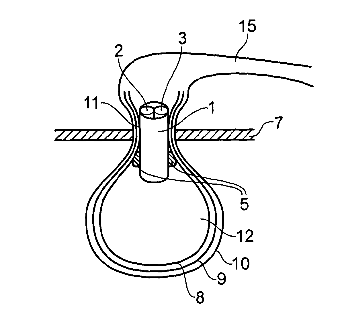 Medical device: laparoscopic bag