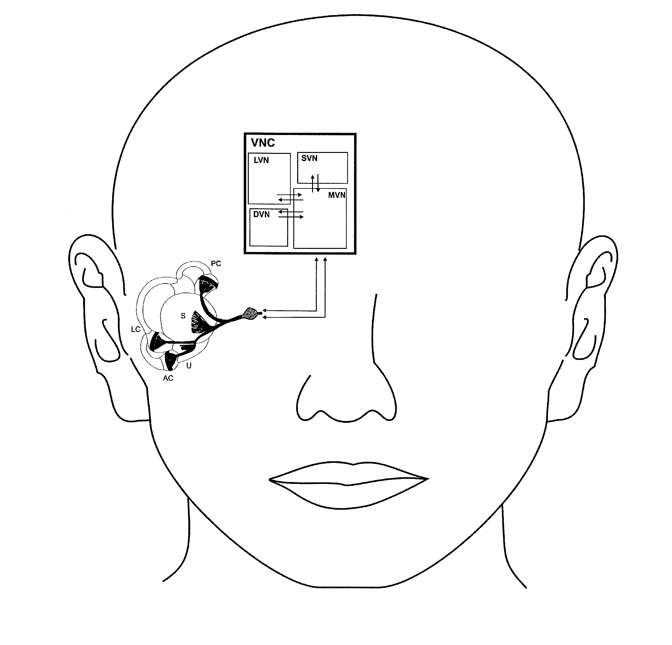 Vestibular prosthesis