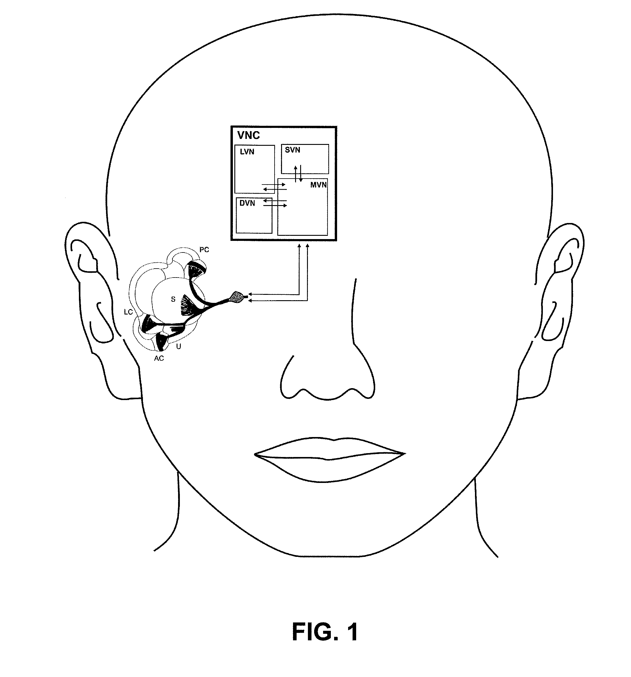 Vestibular prosthesis