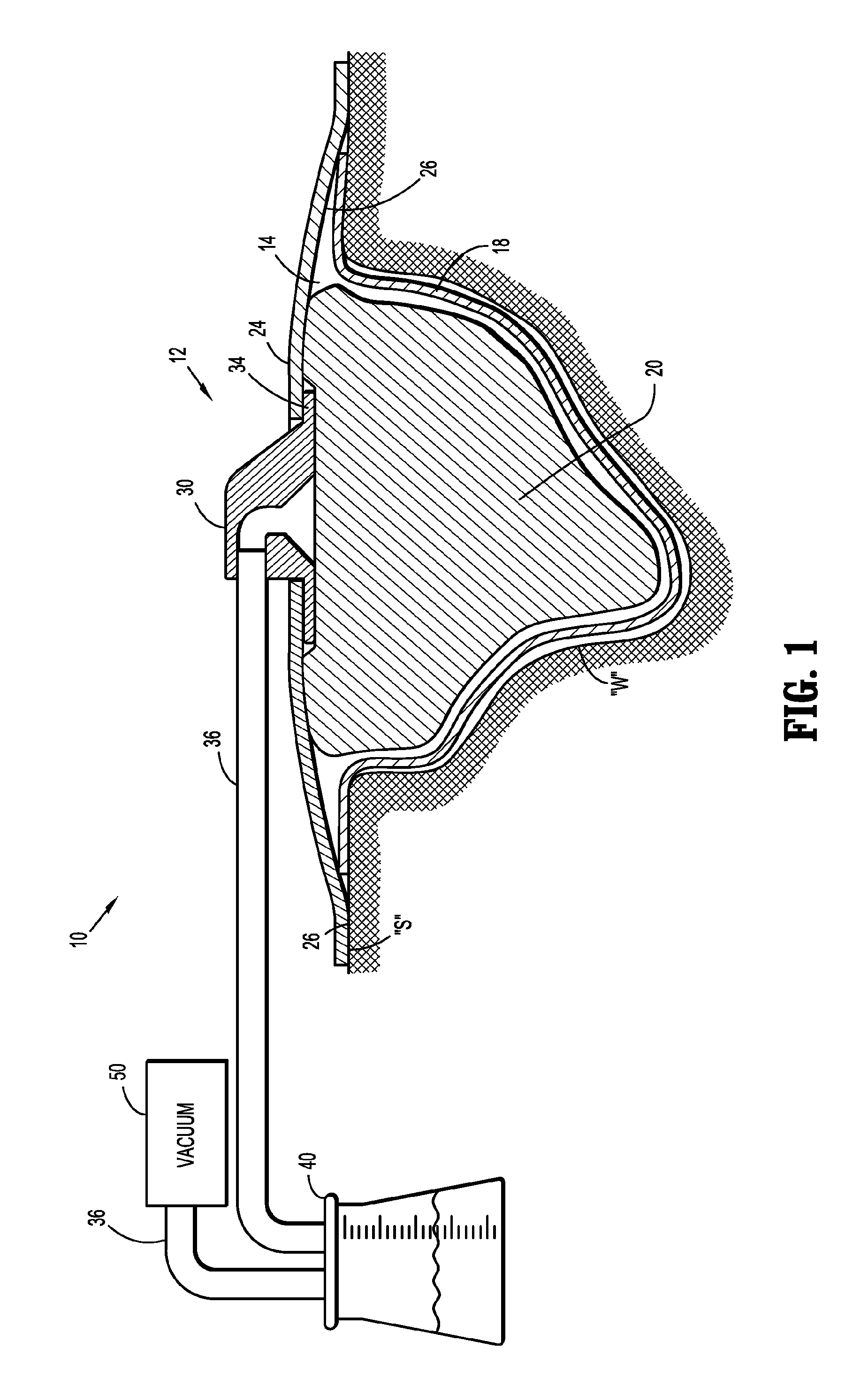 Negative pressure wound therapy dressing