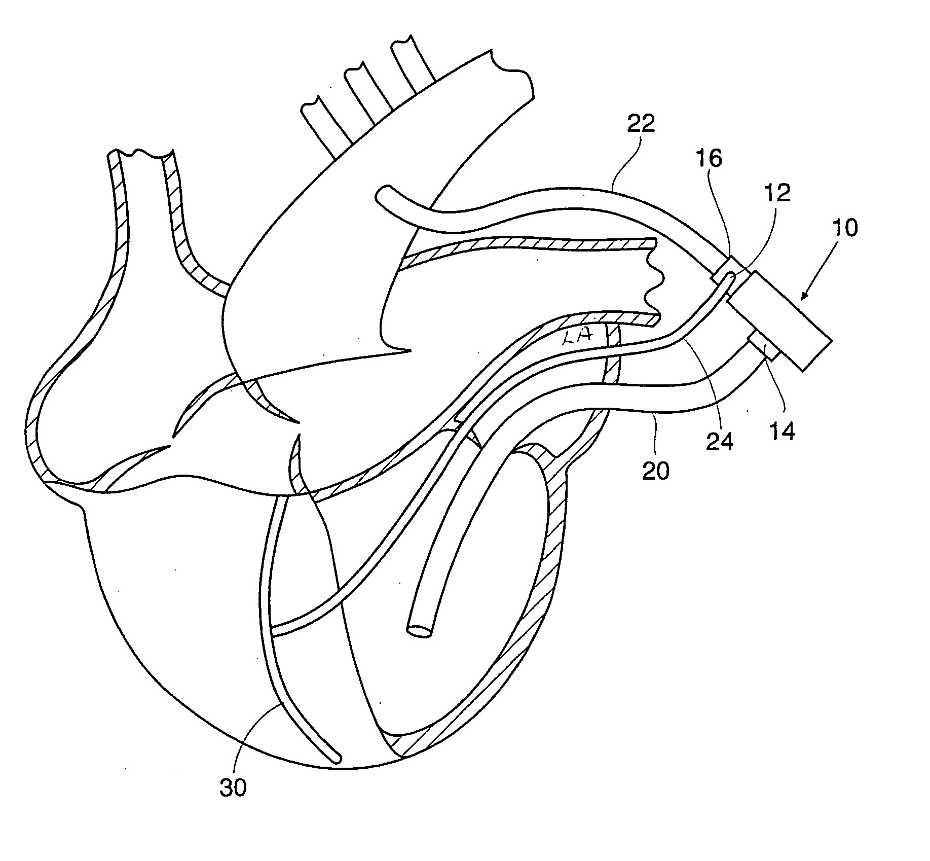 Supplemental port for catheter perfusion of surgical site and methods of use