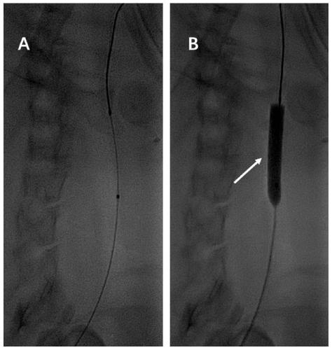 Construction method of carotid atherosclerosis plaque animal model