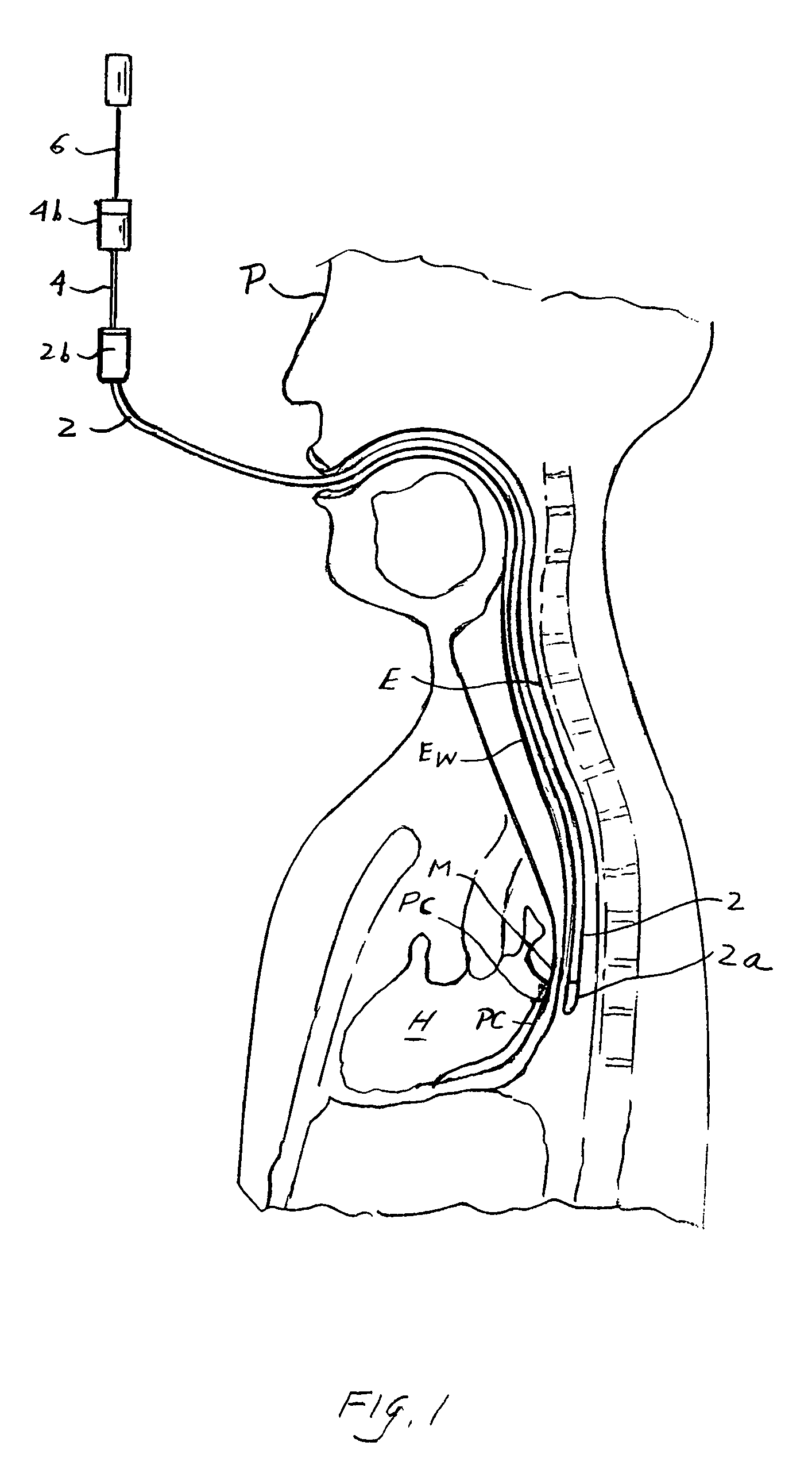 Method and apparatus for performing transgastric procedures