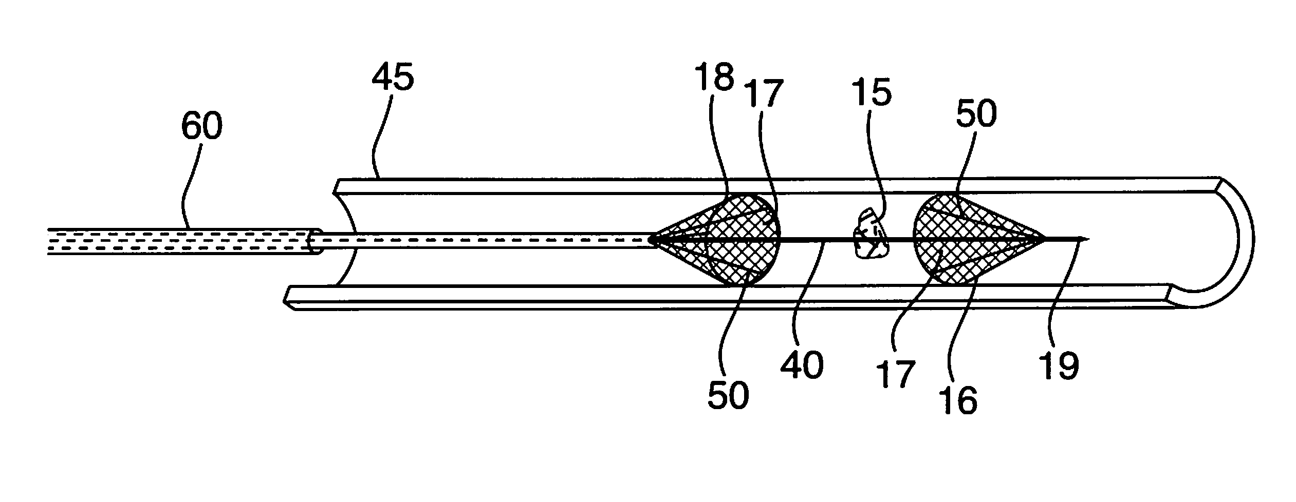 Minimally Invasive Thrombectomy