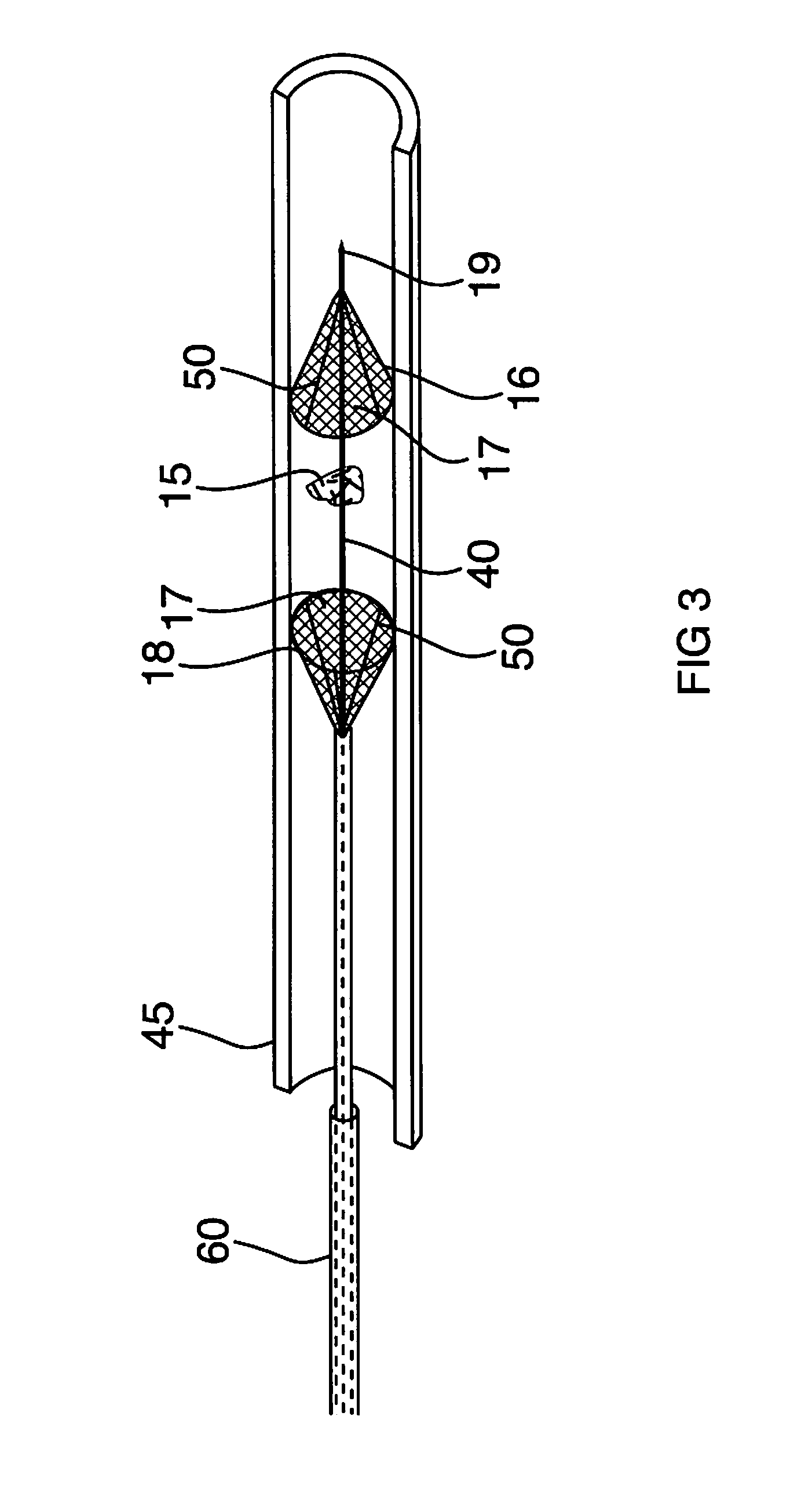 Minimally Invasive Thrombectomy