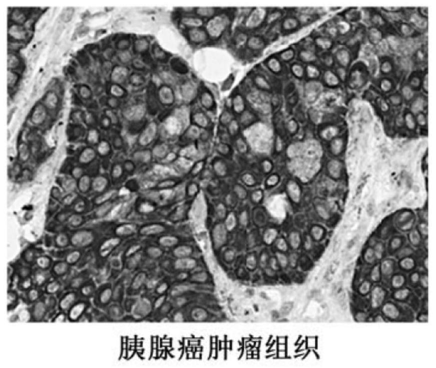 Use of tumor-derived IgG in the diagnosis or prognosis of pancreatic cancer