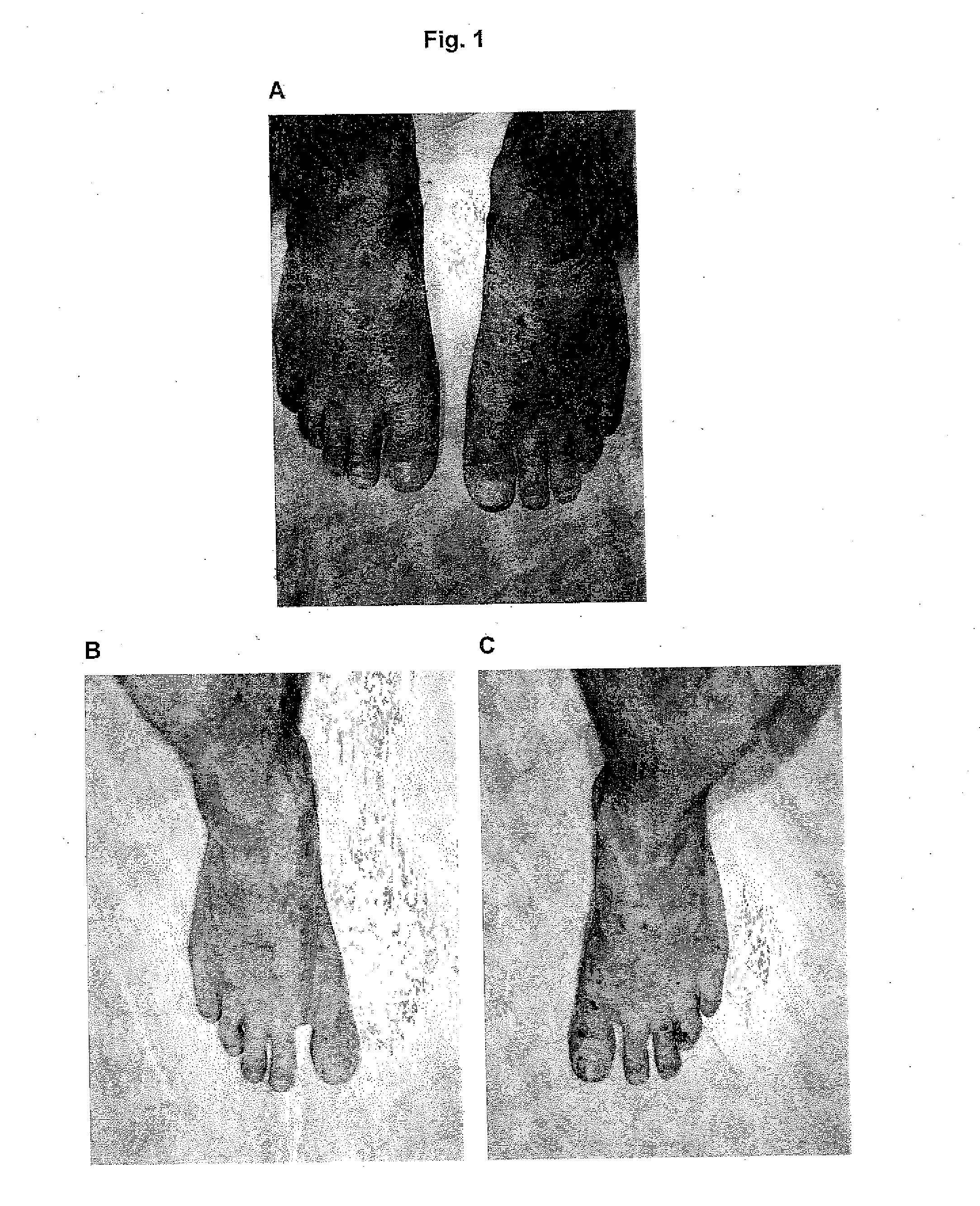 Combination preparation including a cytokine antagonist and corticosteroid