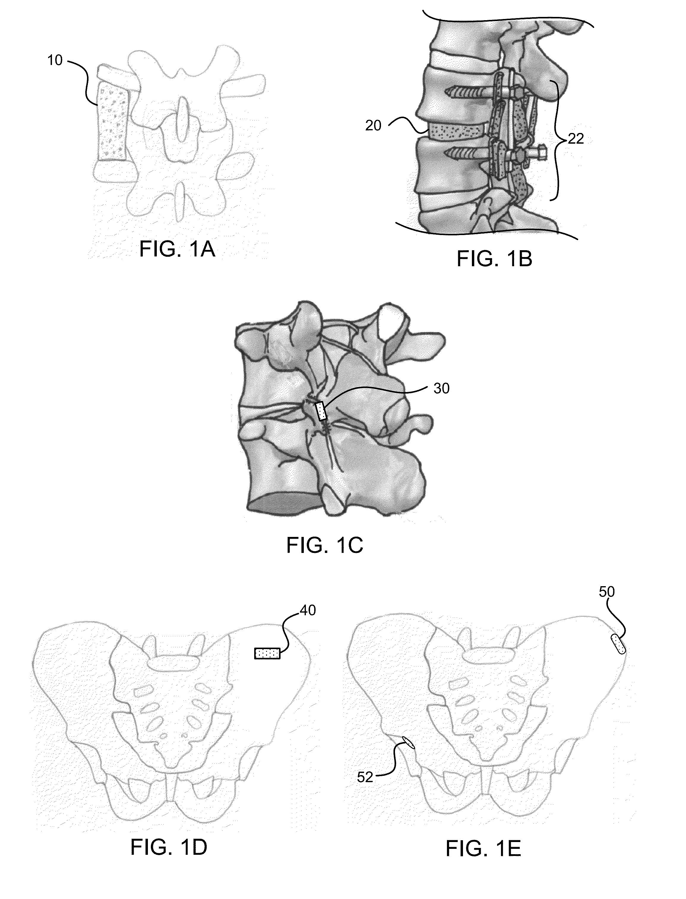 Bone graft materials and methods