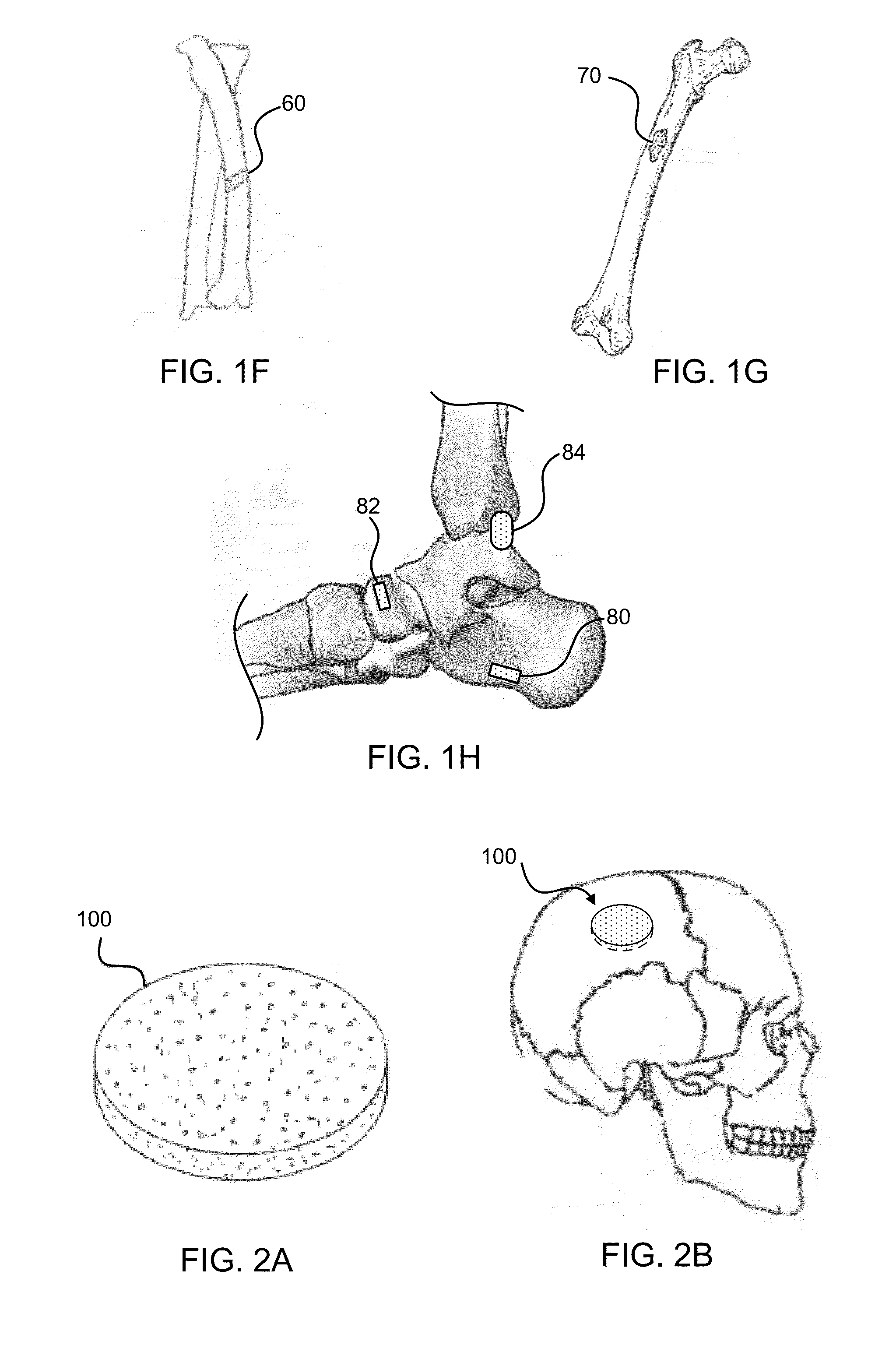 Bone graft materials and methods