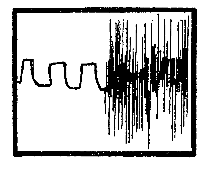 Plastically deformable implant