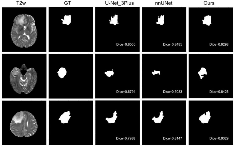 Magnetic resonance imaging brain glioma IDH gene prediction method and system