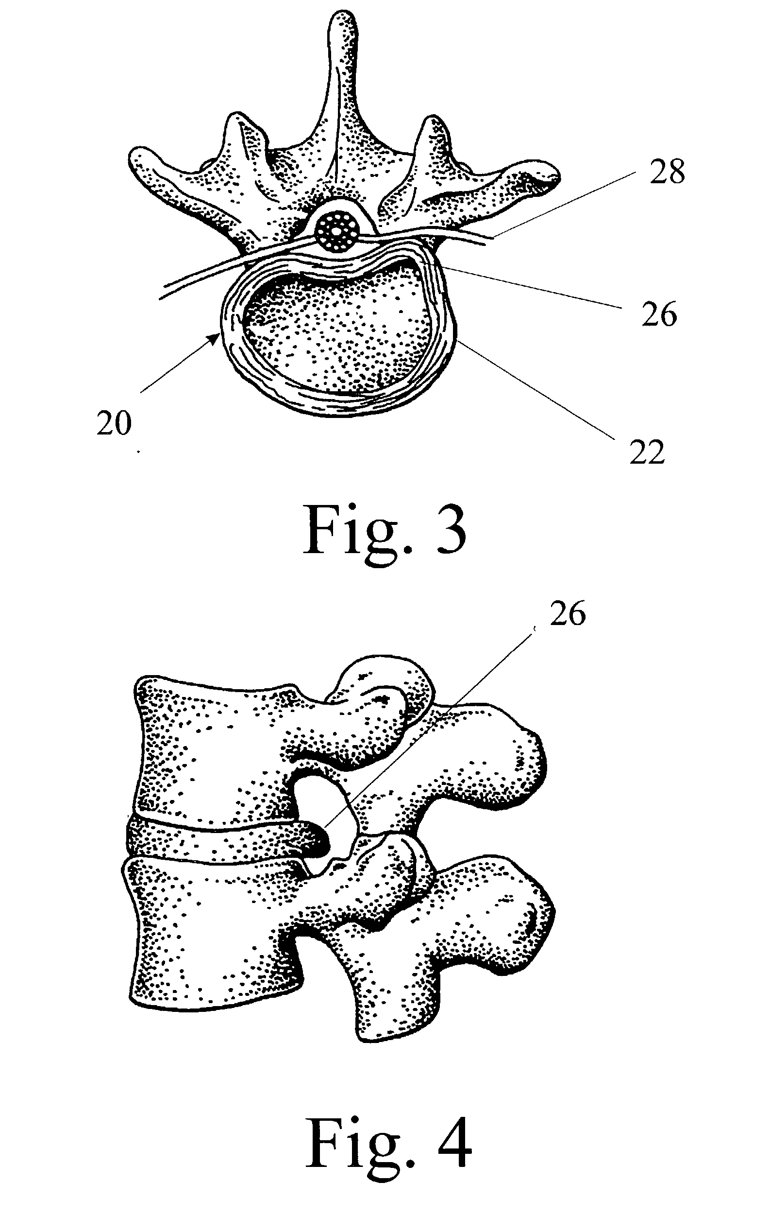 Multiportal device and method for percutaneous surgery