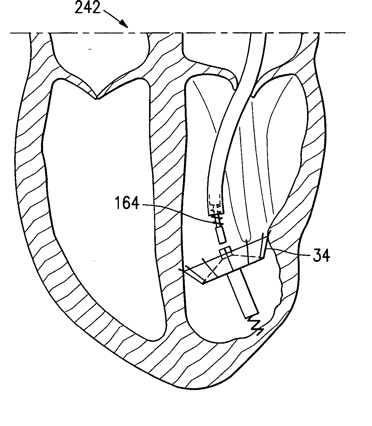 System for improving cardiac function