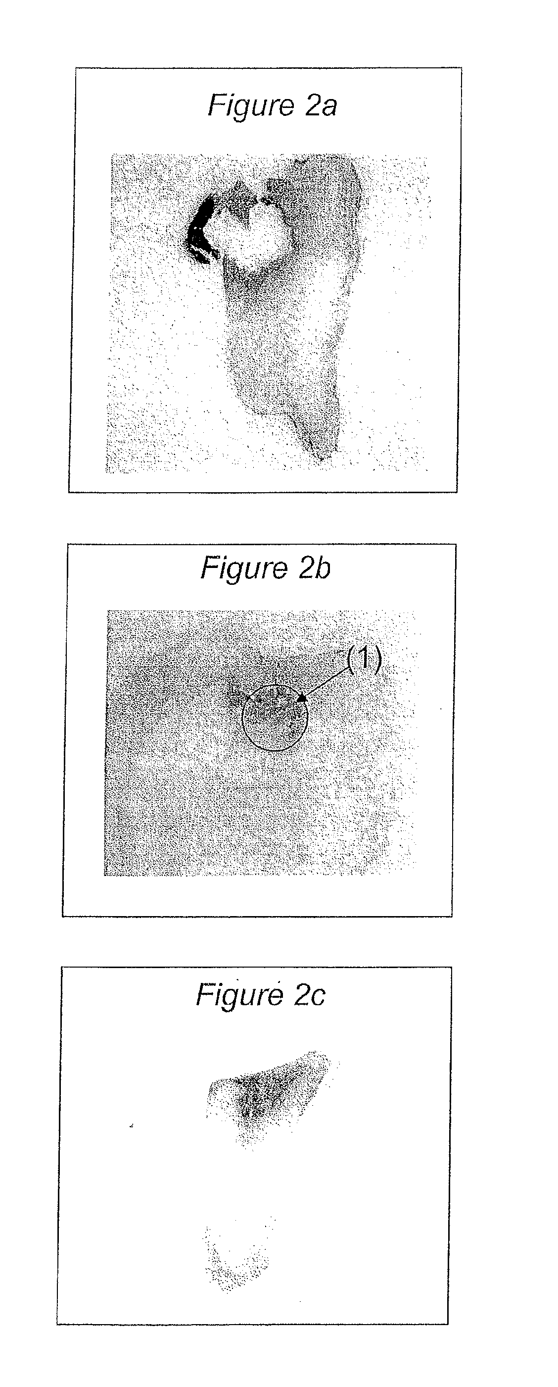 Detection and removal of carious dentin tissue