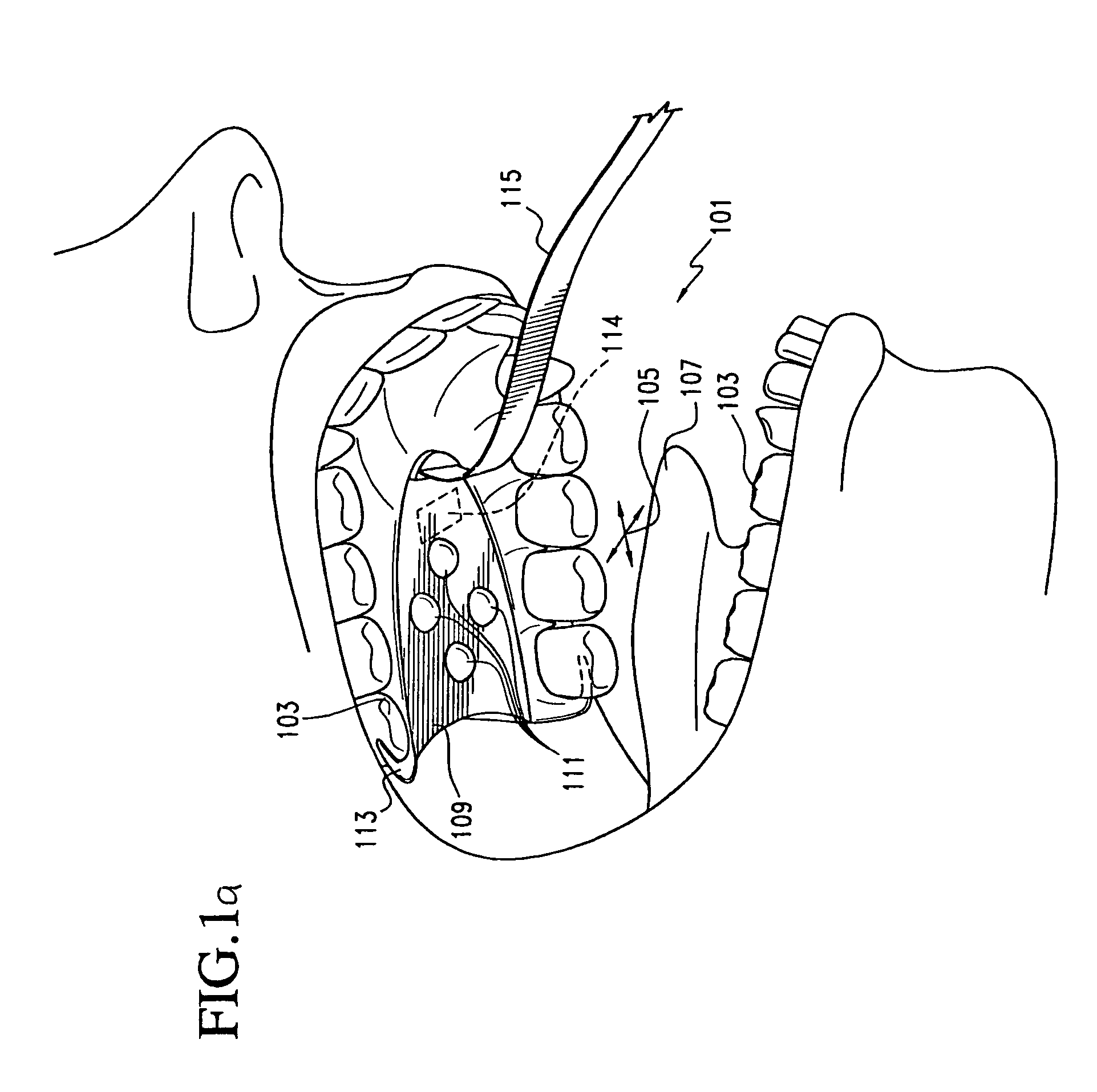 Tongue-operated input device for control of electronic systems