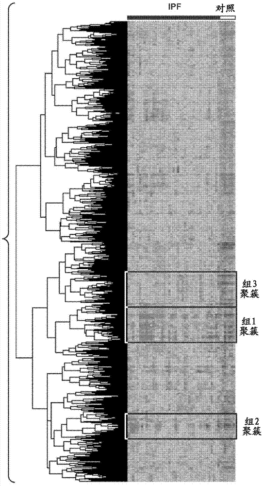 Methods of prognosing, diagnosing and treating idiopathic pulmonary fibrosis