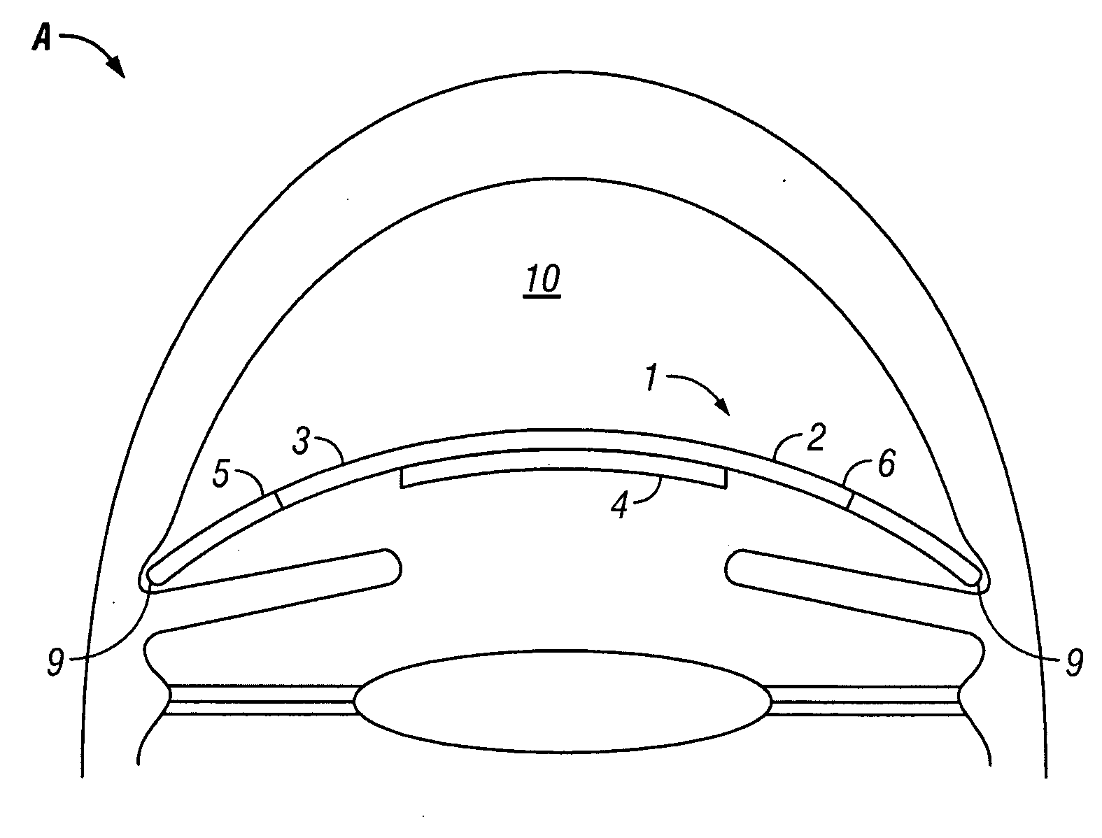 Intraocular thin lens for anterior chamber installation