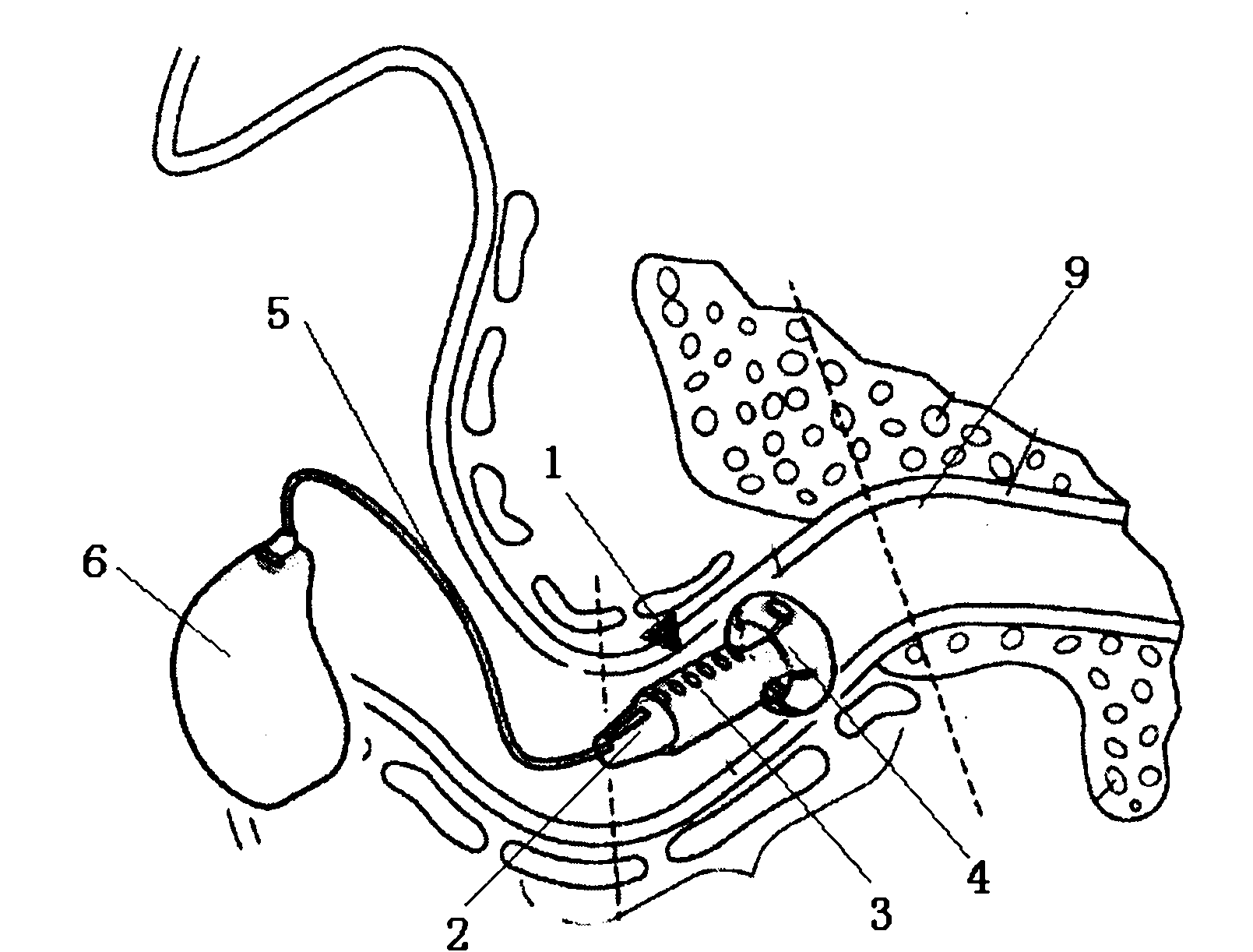 Ear mold and open-type intra-aural receiving deaf-aid