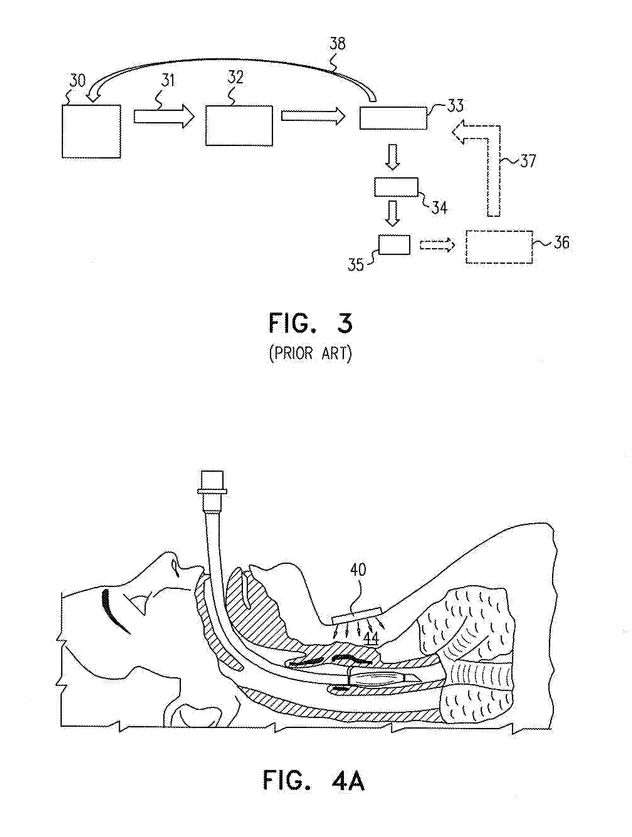 Guided endotracheal intubation system