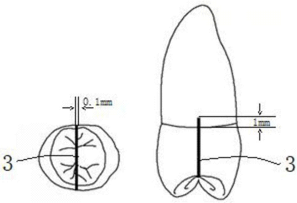 Application of fiber post to preparation of pulp penetrating type cracked molar prosthesis