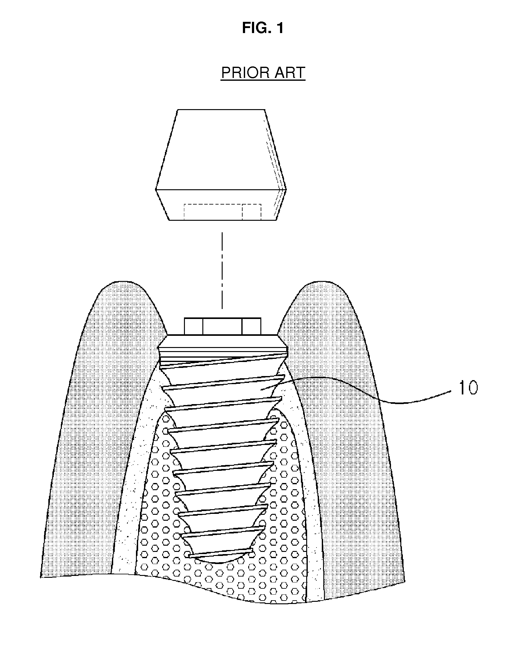 Dental implant