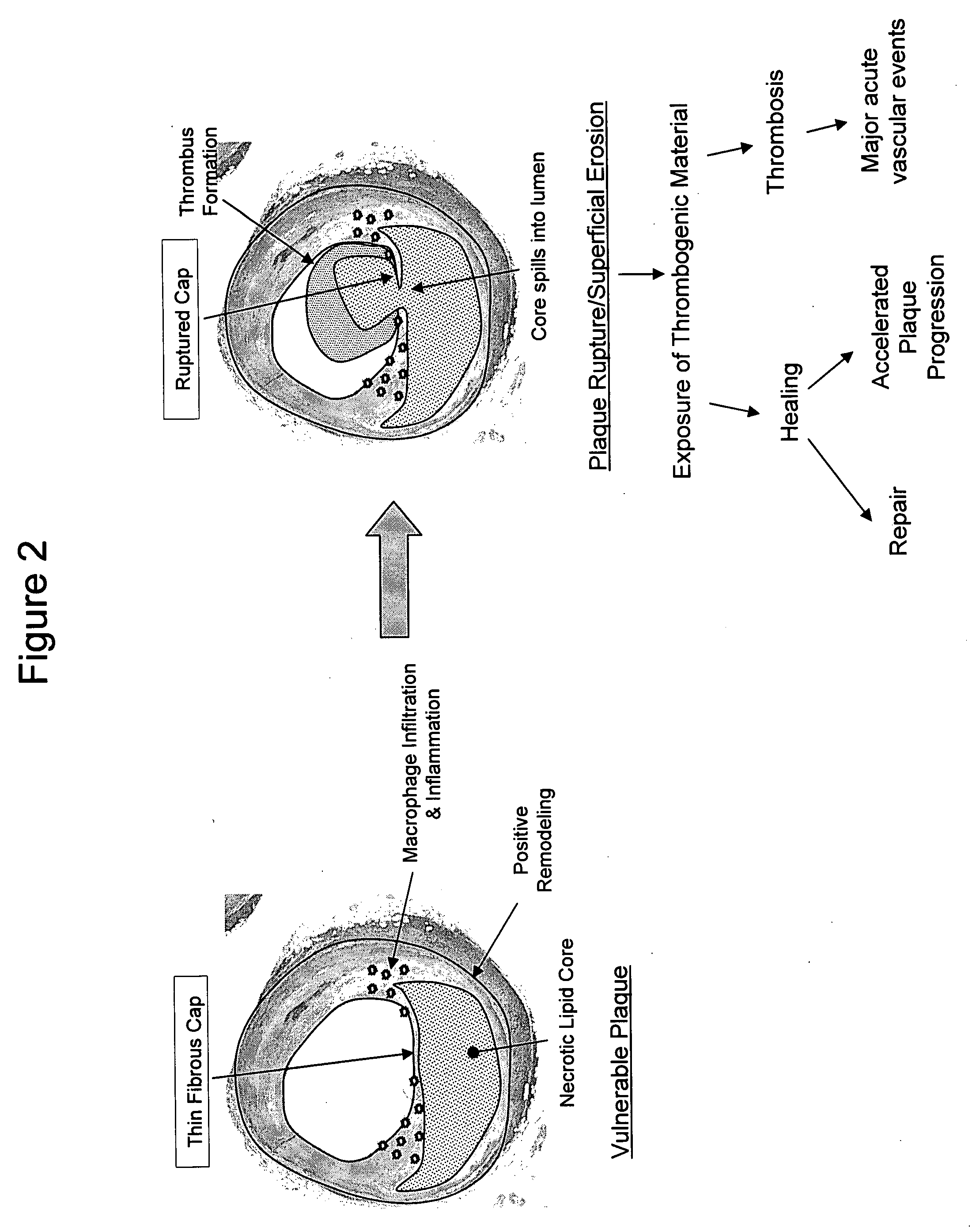 Composite vascular prosthesis