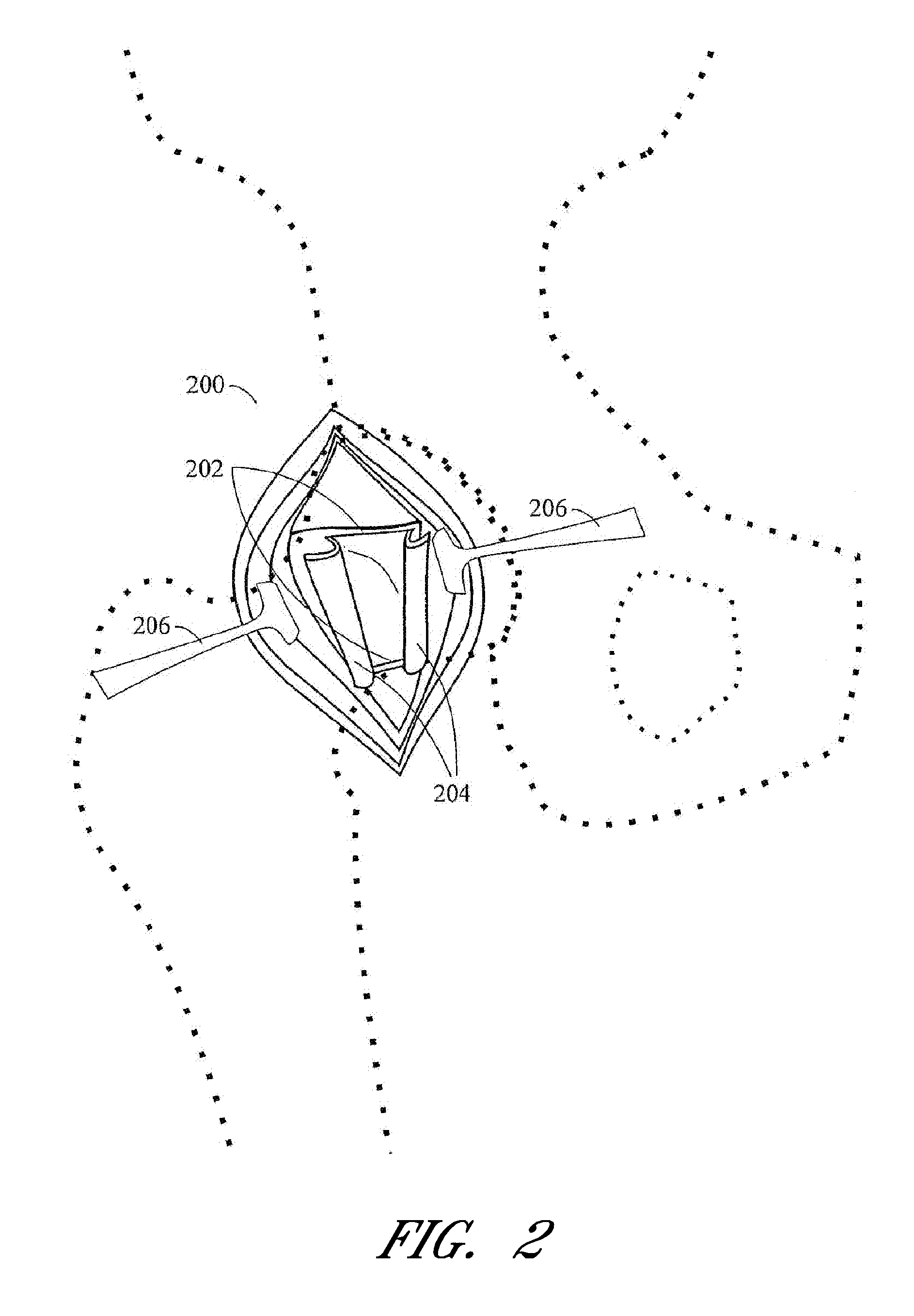 Method and apparatus for hip replacement