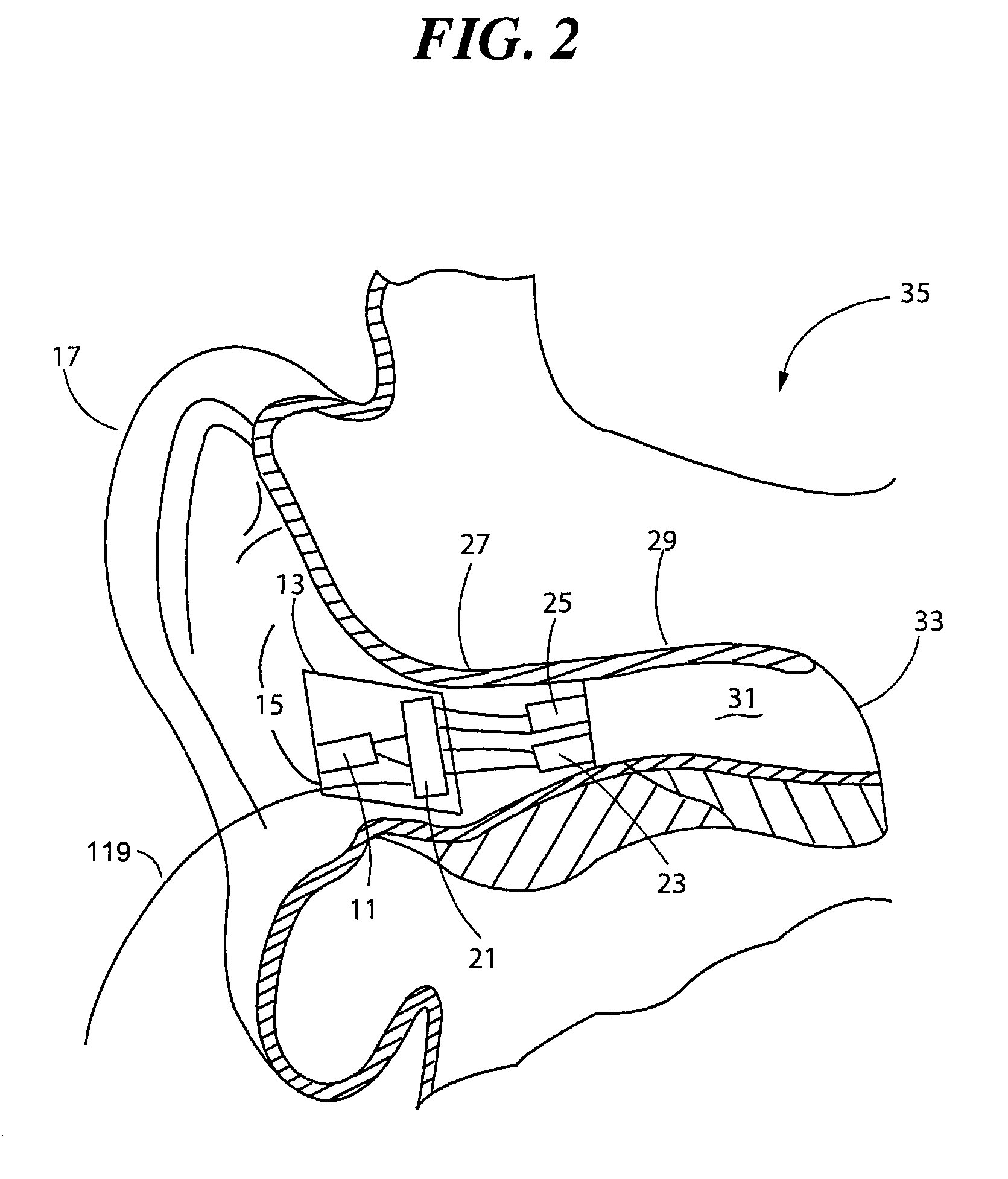 Ear input sound pressure level monitoring system