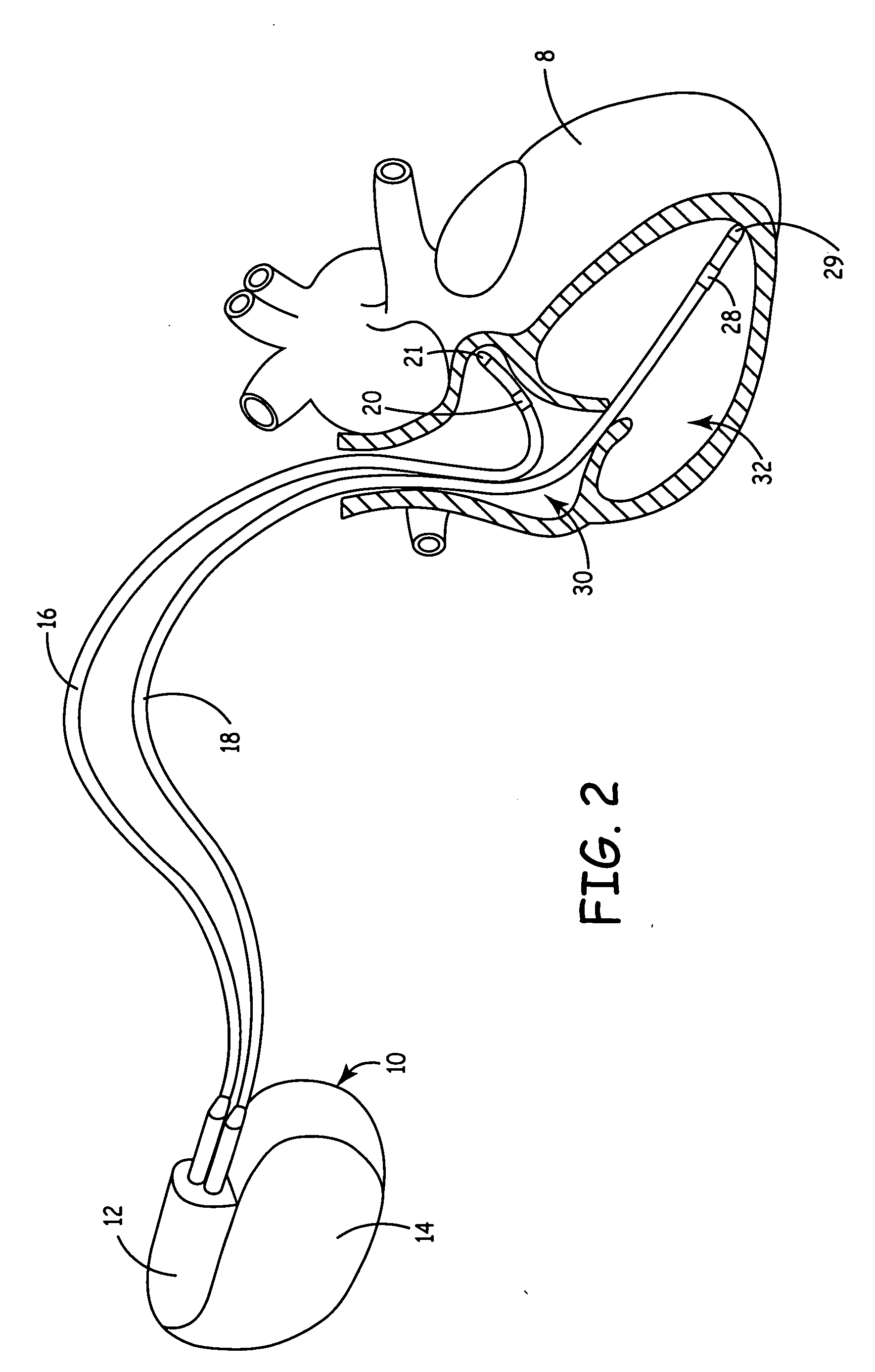 Implantable medical device with ventricular pacing protocol