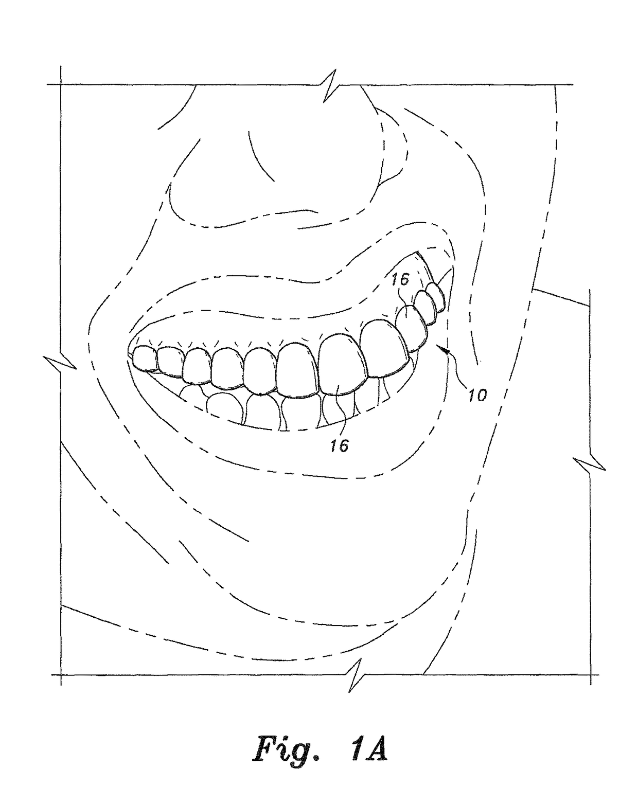 Removable veneers for teeth