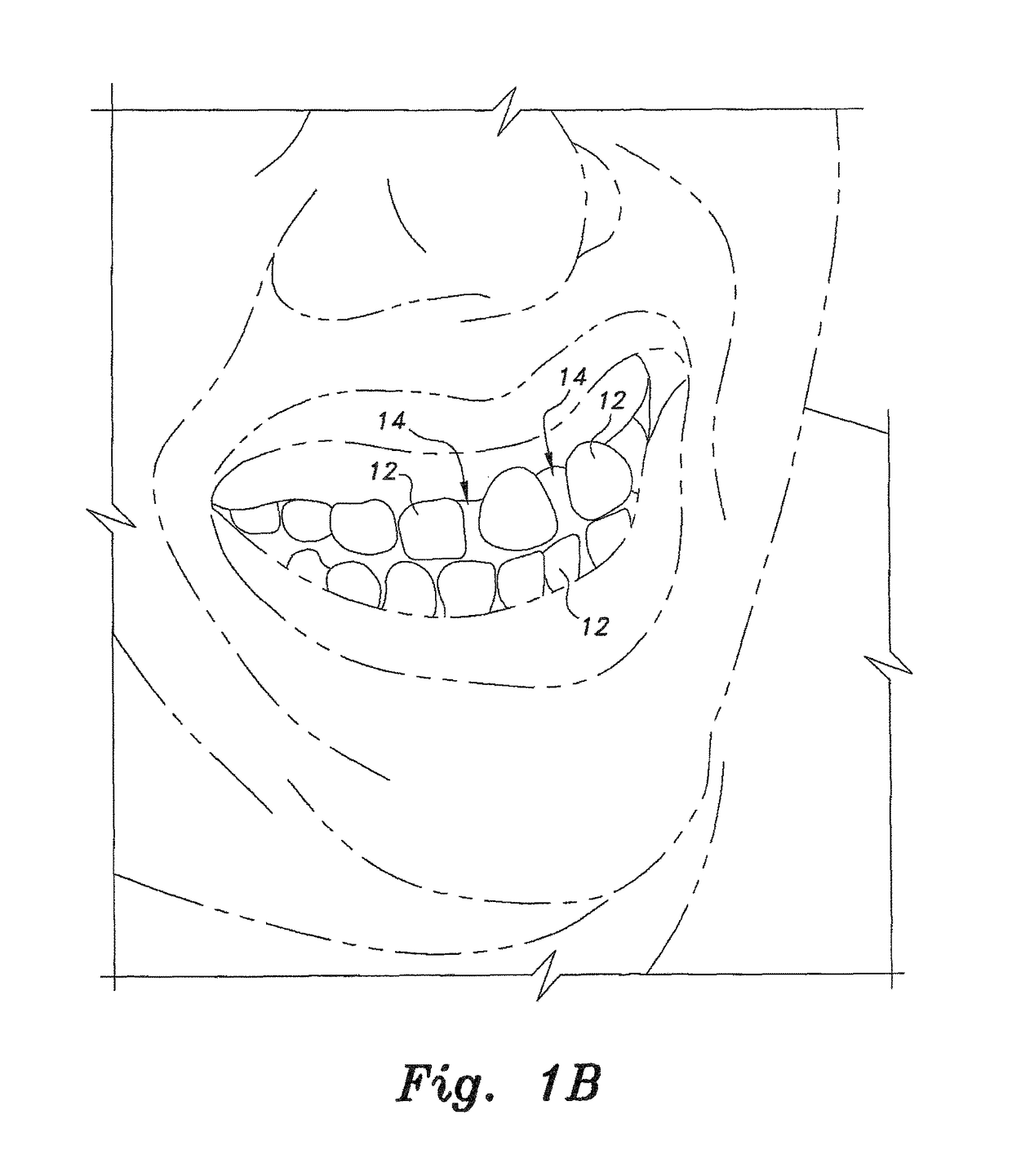 Removable veneers for teeth