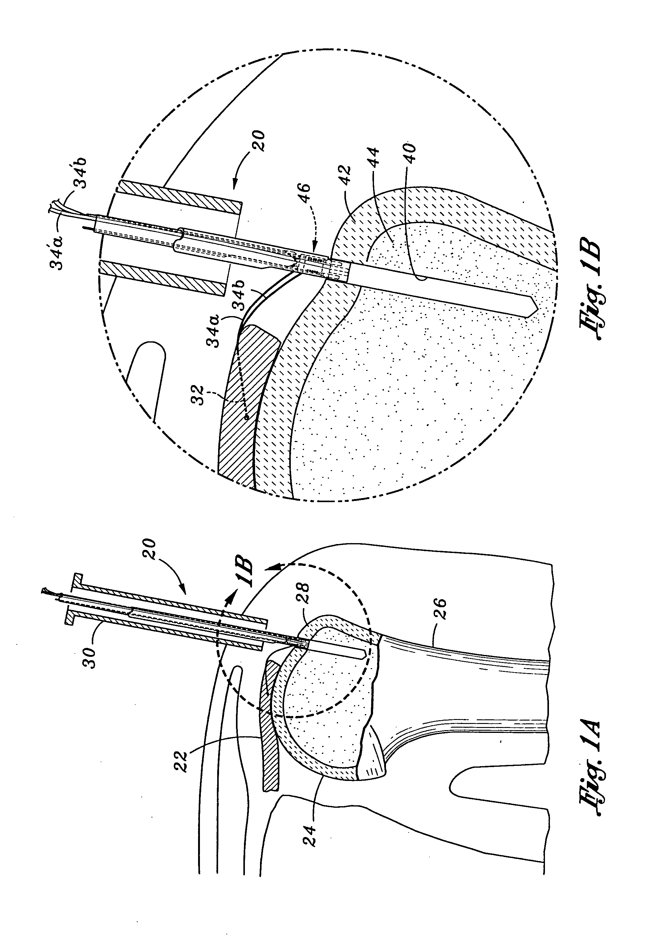 Method and apparatus for attaching connective tissues to bone using a knotless suture anchoring device