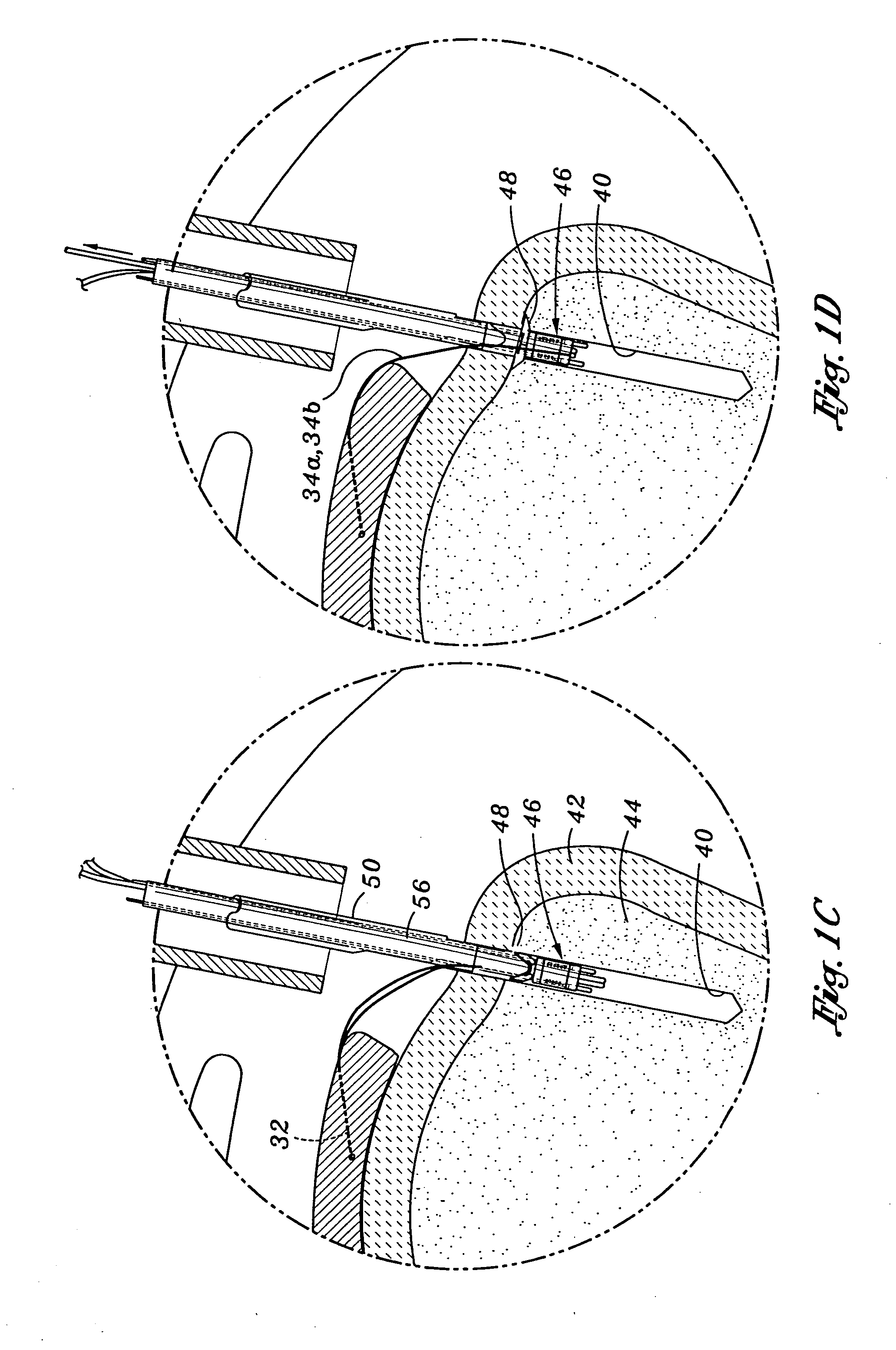 Method and apparatus for attaching connective tissues to bone using a knotless suture anchoring device