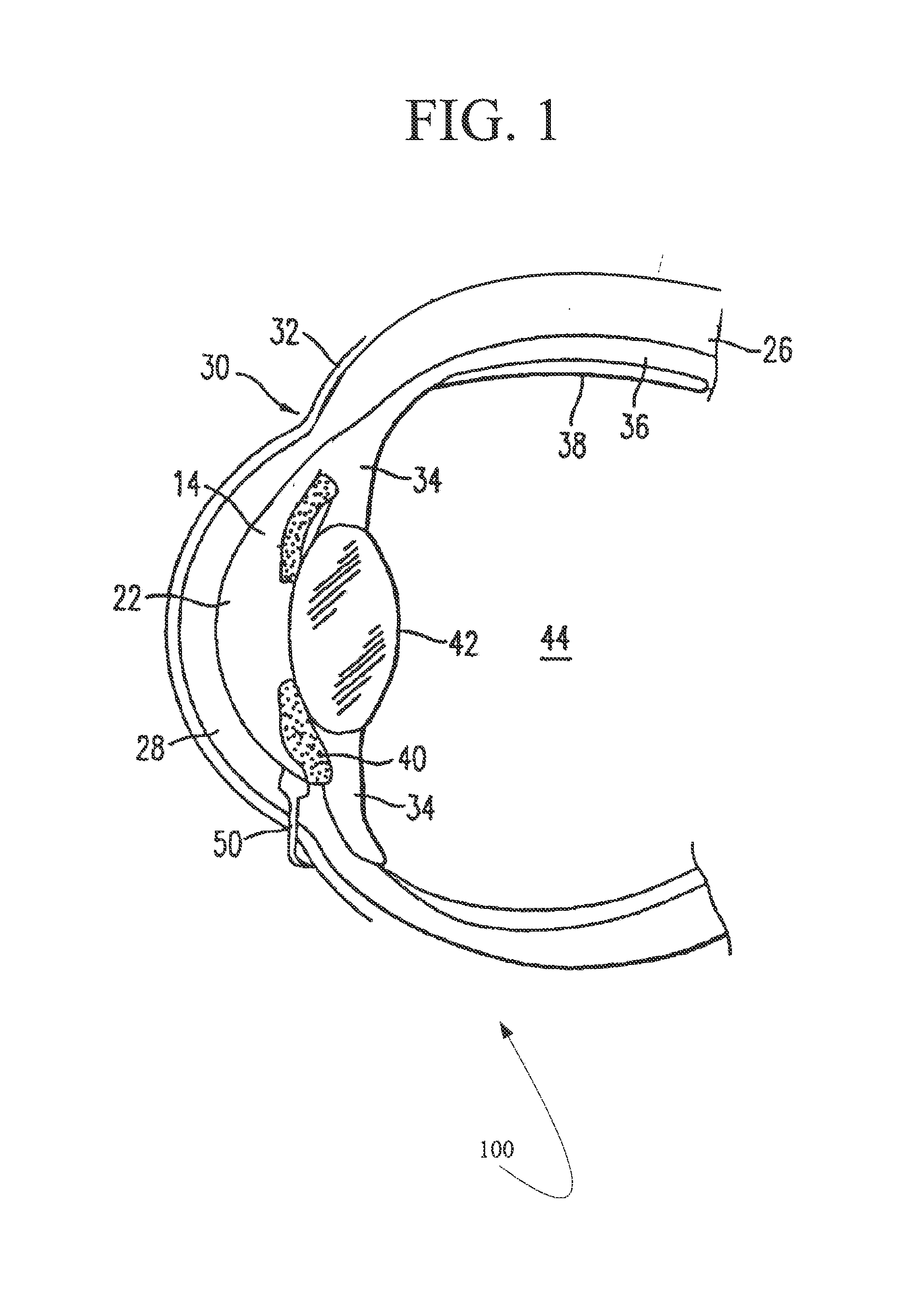 Biocompatible Glaucoma Drainage Device