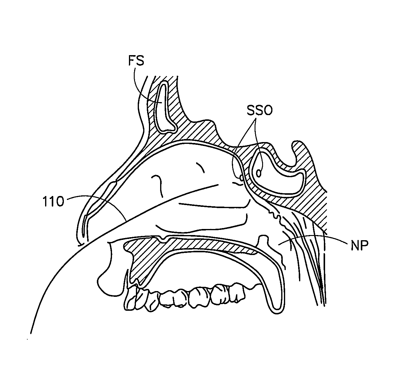 Corewire design and construction for medical devices