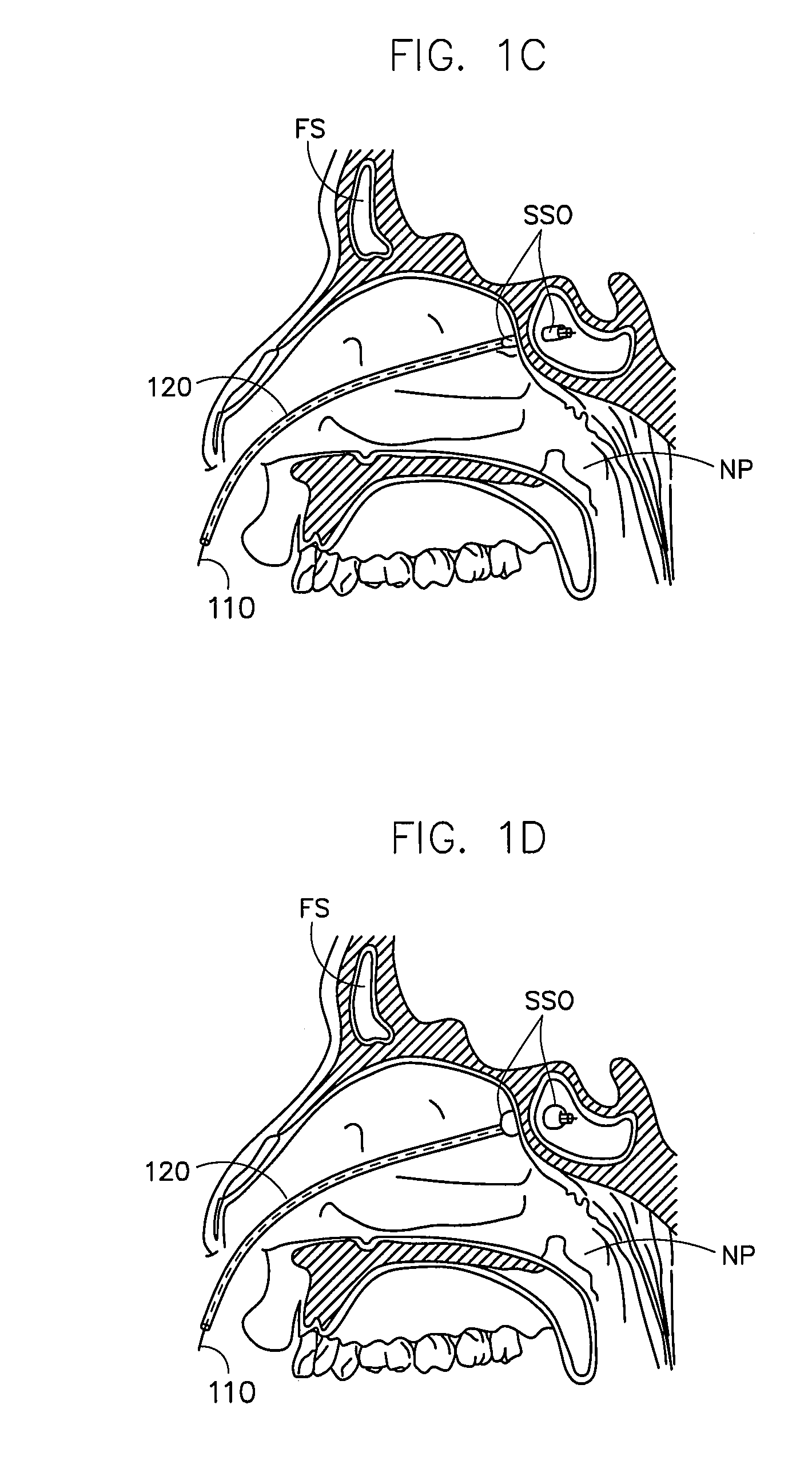 Corewire design and construction for medical devices