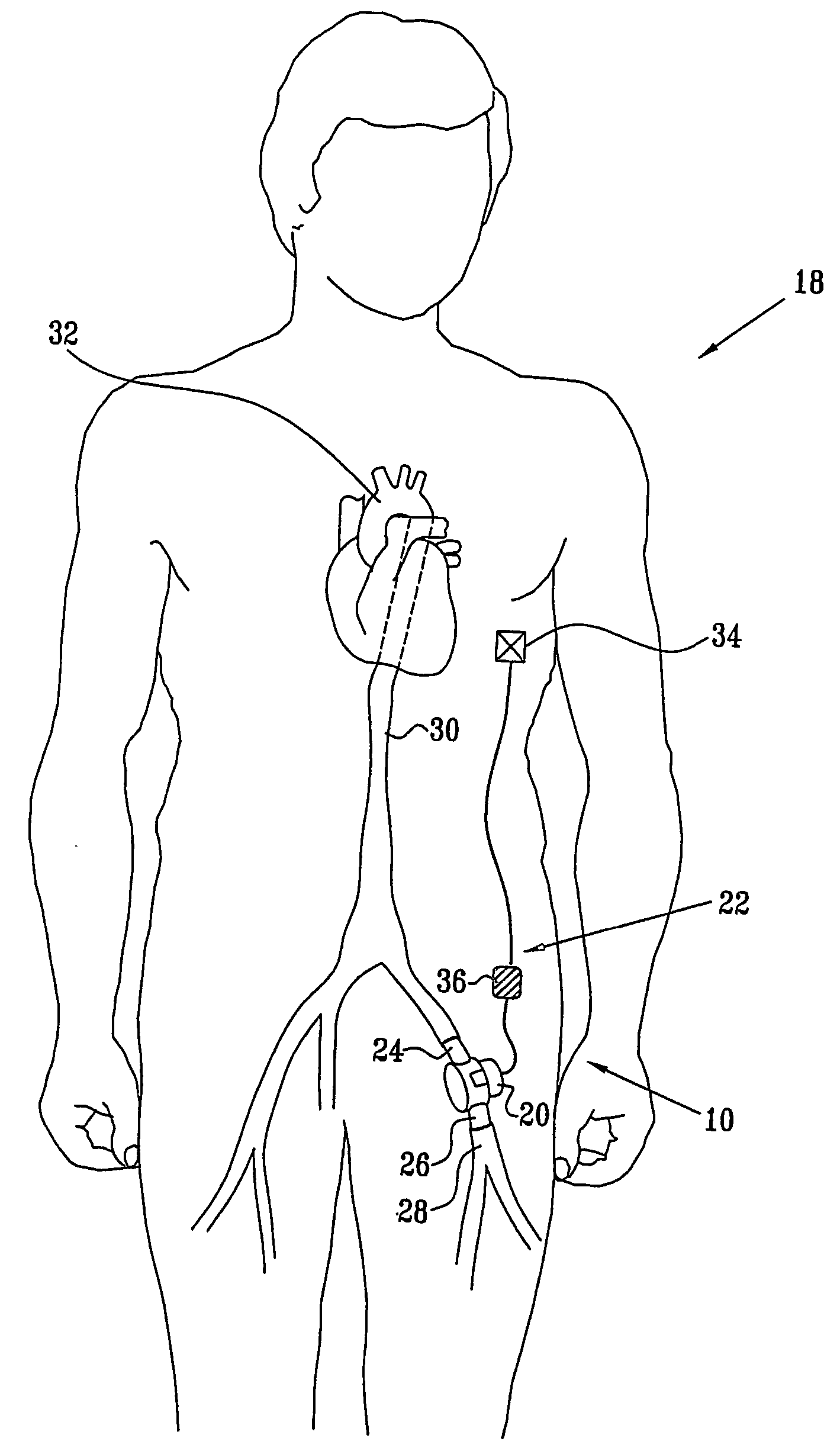 Fully-implantable cardiac recovery system