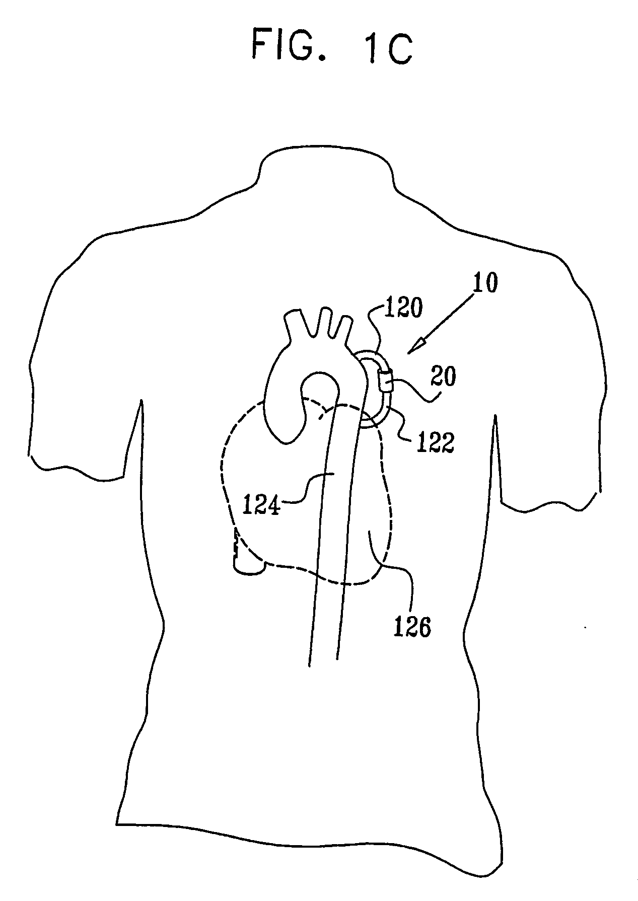 Fully-implantable cardiac recovery system