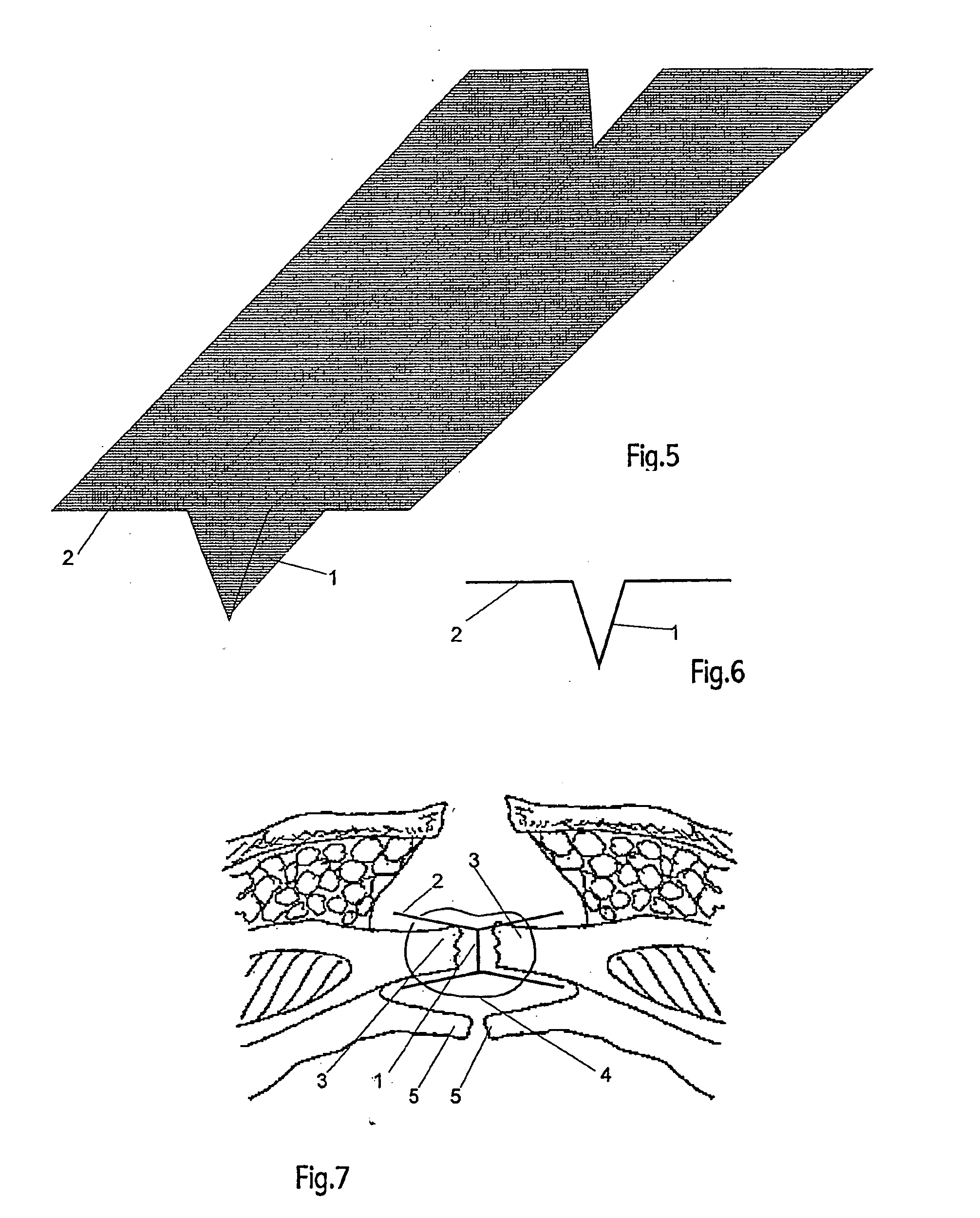 Wall prosthesis that can be implanted in the center of a wound to reinforce abdominal wall closure