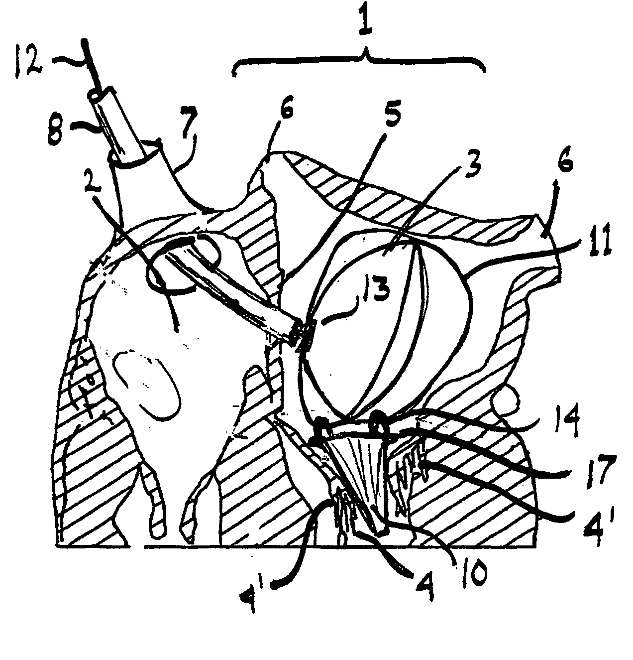 Artificial mitral valve