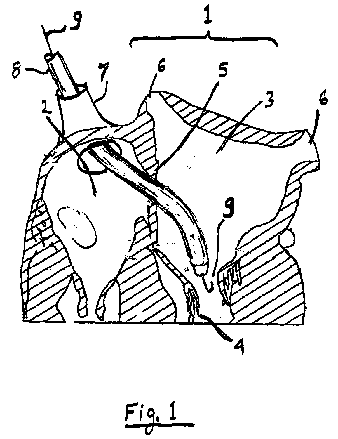 Artificial mitral valve