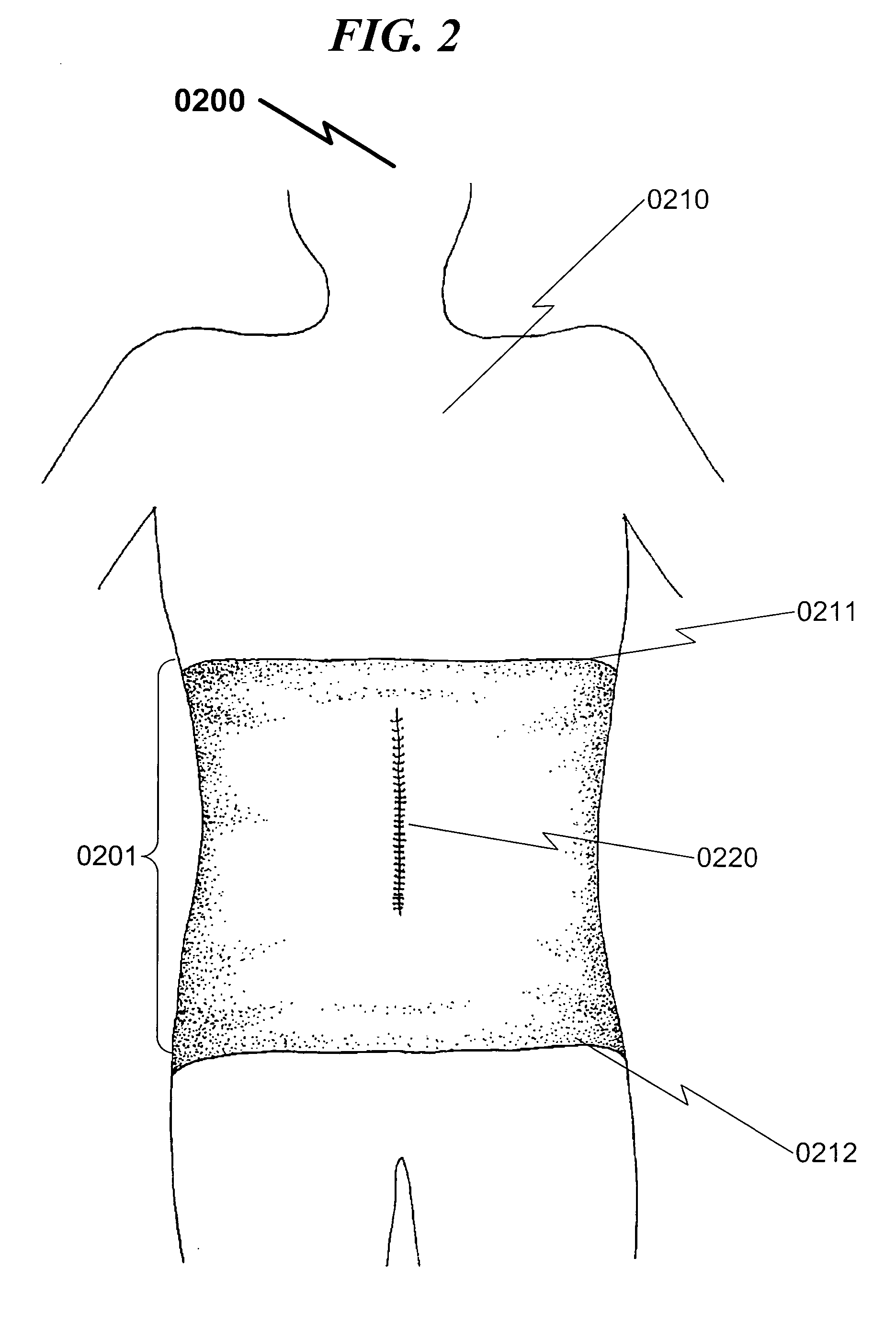 Surgical binder undergarment system and method